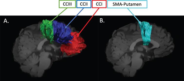 Pathway regions of interest. Sagittal views of the reconstructed WM pathways displayed on a T1-weighted image for one control participant. (A) CCI, CCII, and CCIII [64]: CCI is the most anterior portion of the CC and maintains prefrontal connections between both hemispheres; CCII is the portion that maintains connections between premotor and supplementary motor areas of both hemispheres. CCIII maintains connections between primary motor cortices of both hemispheres. (B) SMA-putamen pathway: this pathway has efferent and afferent projections to the primary motor cortex and is involved in movement execution.