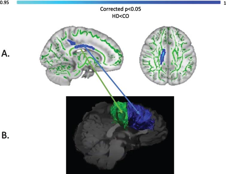 TBSS analysis of baseline MPF values (A). Light blue areas show a significant reduction of MPF in patients with HD compared to controls (p < 0.05, FWE corrected). The midbody of the CC was mostly found to be affected, which carries connections to the premotor, supplementary motor and motor areas of the brain. Tracts showing significantly greater MPF changes in HD patients post-training as compared to controls (B). Areas showing significant MPF reductions at baseline overlap with tracts showing significant changes post-training (i.e., CCII and CCIII).