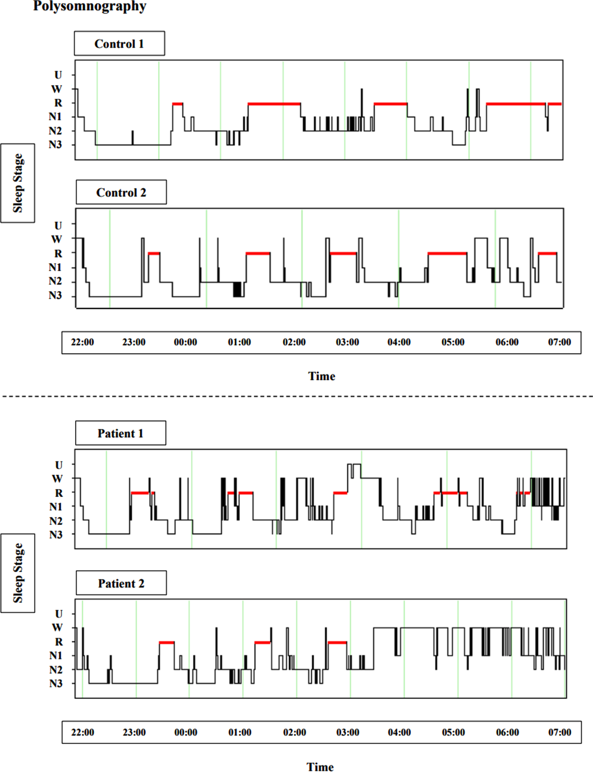 Polysomnography exhibiting insomnia and sleep architecture fragmentation in HD, sourced from ongoing research in our group (unpublished). Figures depict hypnograms from two control examples and two early manifest HD patient examples, between 22:00 and 07:00. U, unscored; W, wake; R, rapid eye movement (red); N1, stage 1 sleep; N2, stage 2 sleep; N3, slow wave sleep.
