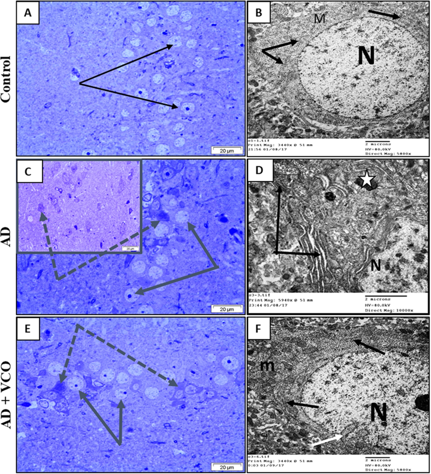 Semi-thin sections and electron-ultramicrographs of rat hippocampi of the three study groups. (A) Control: The semi-thin toluidine blue-stained section shows normal neurons with vesicular nuclei and prominent nucleoli (arrows). (B) Control: electron microscope micrograph shows a normal neuron with euchromatic nucleus (N), healthy cytoplasmic rER (black arrows) and mitochondria (M). (C) AD: Semi-thin sections show shrunken dark-stained neurons (dotted arrows). Cell nuclei are ill-defined, dark and degenerated. Few neurons looked normal with vesicular nuclei and prominent nucleoli (arrows). (D) AD: electron microscope micrograph shows a degenerated neuron with electron-dense cytoplasm and dilated rER depleted from ribosomes (black arrows). Dense bodies (lysosomes) can be seen (white star). The nucleus (N) shows clumped chromatin. (E) AD+VCO: Semi-thin sections show the preservation of normal viable neurons (black arrows). A few cells looked dark, shrunken and degenerated (dotted arrow). (F) AD+VCO: electron microscope micrograph shows a nearly normal neuron with a euchromatic nucleus (N) and indented envelope (white arrow). The cytoplasm contains normal rER (black arrows) and mitochondria (M). Scale bar=20μm in A, C and E and 2 μm in B, D and F.