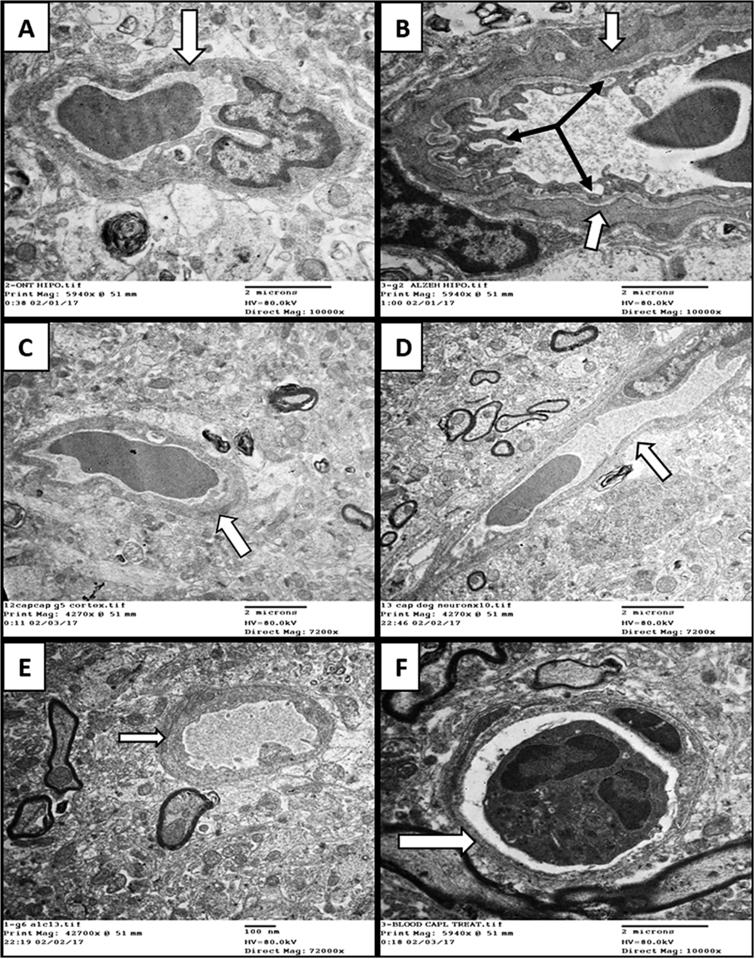 Electron-ultramicrographs of blood capillaries in the three study groups. (A) Control hippocampus capillary showing normal thickness basement membrane (white arrows). (B) AD hippocampus capillary with marked thickening of basement membrane (white arrows), irregular endothelial lining and vascular degeneration (black arrows). (C) AD+VCO hippocampus capillary with normal basement membrane and endothelial lining. (D) Control cerebral cortex capillary with normal thickness basement membrane; notice the myelinated nerves nearby. (E) AD cerebral cortex capillary showing the thickening of basement membrane. (F) Cerebral cortex AD+VCO capillary with the preservation of the normal basement membrane capillary structure (white arrow).