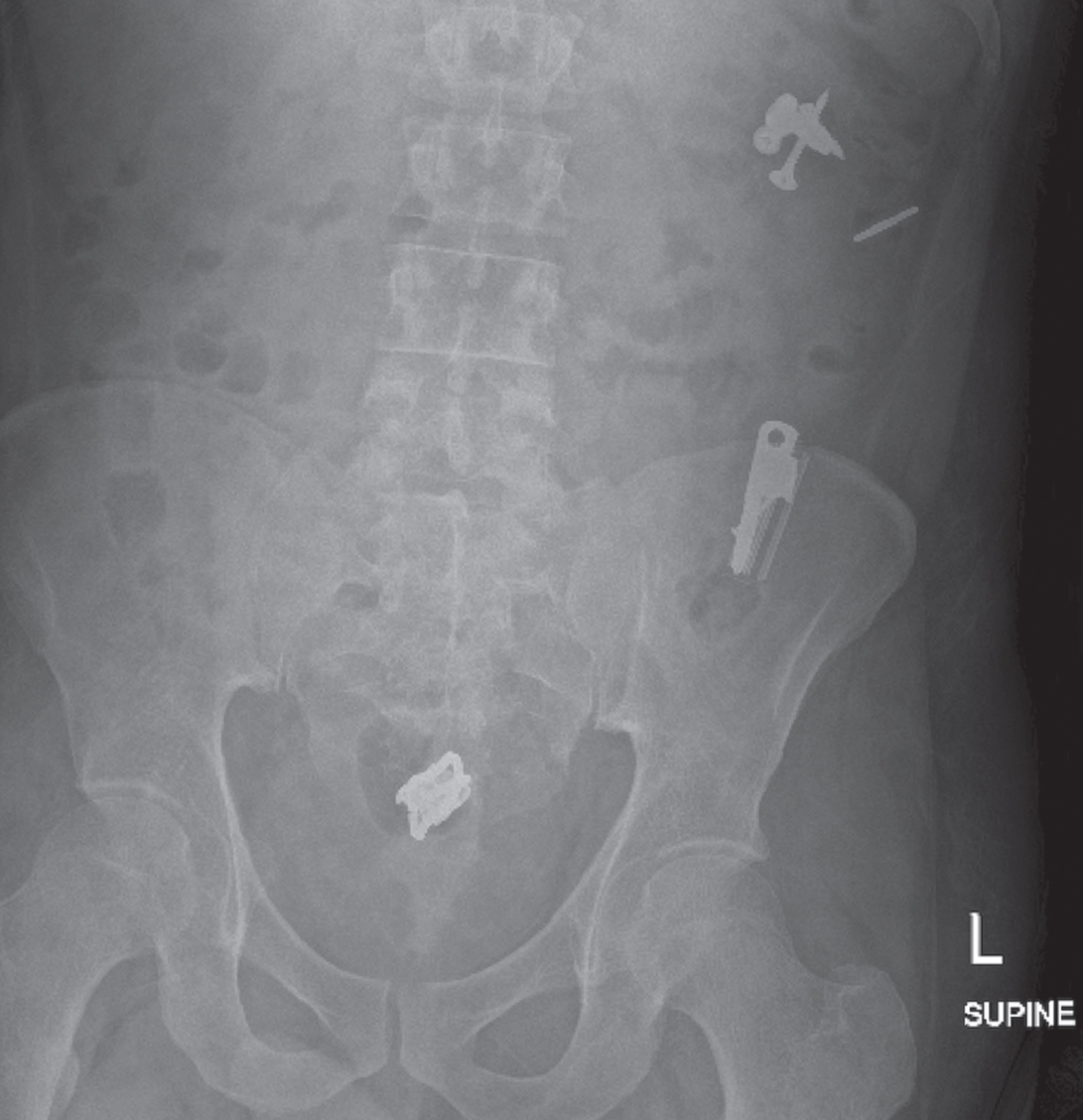Abdominal x-ray depicting screws and nails in the left upper quadrant, likely in the distal transverse colon or small bowel. There is a linear radiodense structure over the proximal descending colon as well. Multiple radiodense structures are depicted over the mid-descending colon, which are seemingly a nail, razor blade cartridge, and another irregularly shaped object. Multiple overlapping radiodense structures can also be seen projecting over the rectum.