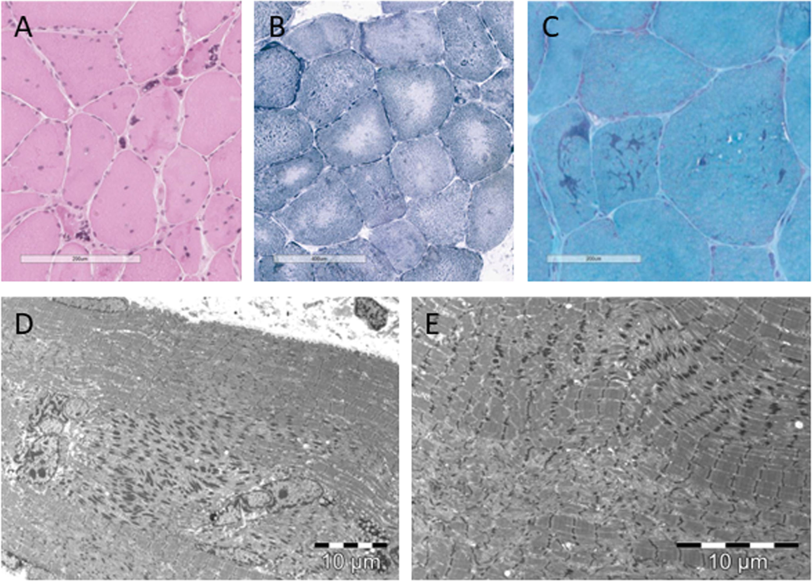 Histopathological characteristics of patient 1. (A) Hematoxylin-eosin staining showing nuclear clumps, internalised nuclei, atrophic and hypertrophic fibres. (B) reduced nicotinamide adenosine dinucleotide tetrazolium reductase (NADH-TR) staining showing cores. (C) modified Gömöri trichrome staining showing rods. (D) electromicroscopic image showing rods and internalised nuclei. (E) electromicroscopic image showing rods and cores.