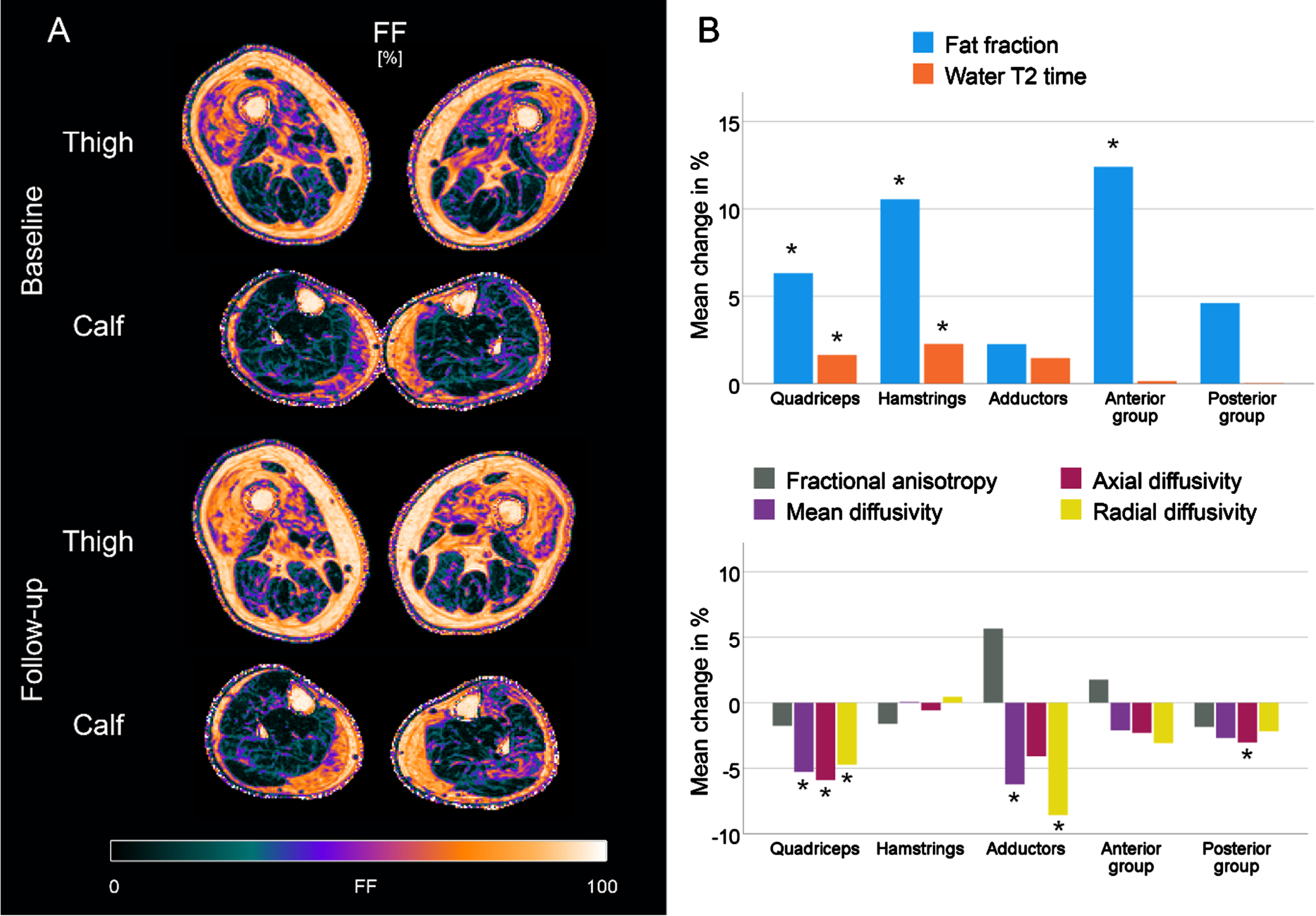 Fat fraction (FF) maps of a representative patient with sporadic inclusion body myositis (sIBM) at baseline and follow-up (A). Bar plots showing the relative mean changes of qMRI metrics in IBM patients between baseline and follow-up, normalized to the mean of both measurements. *adjusted p < 0.05.