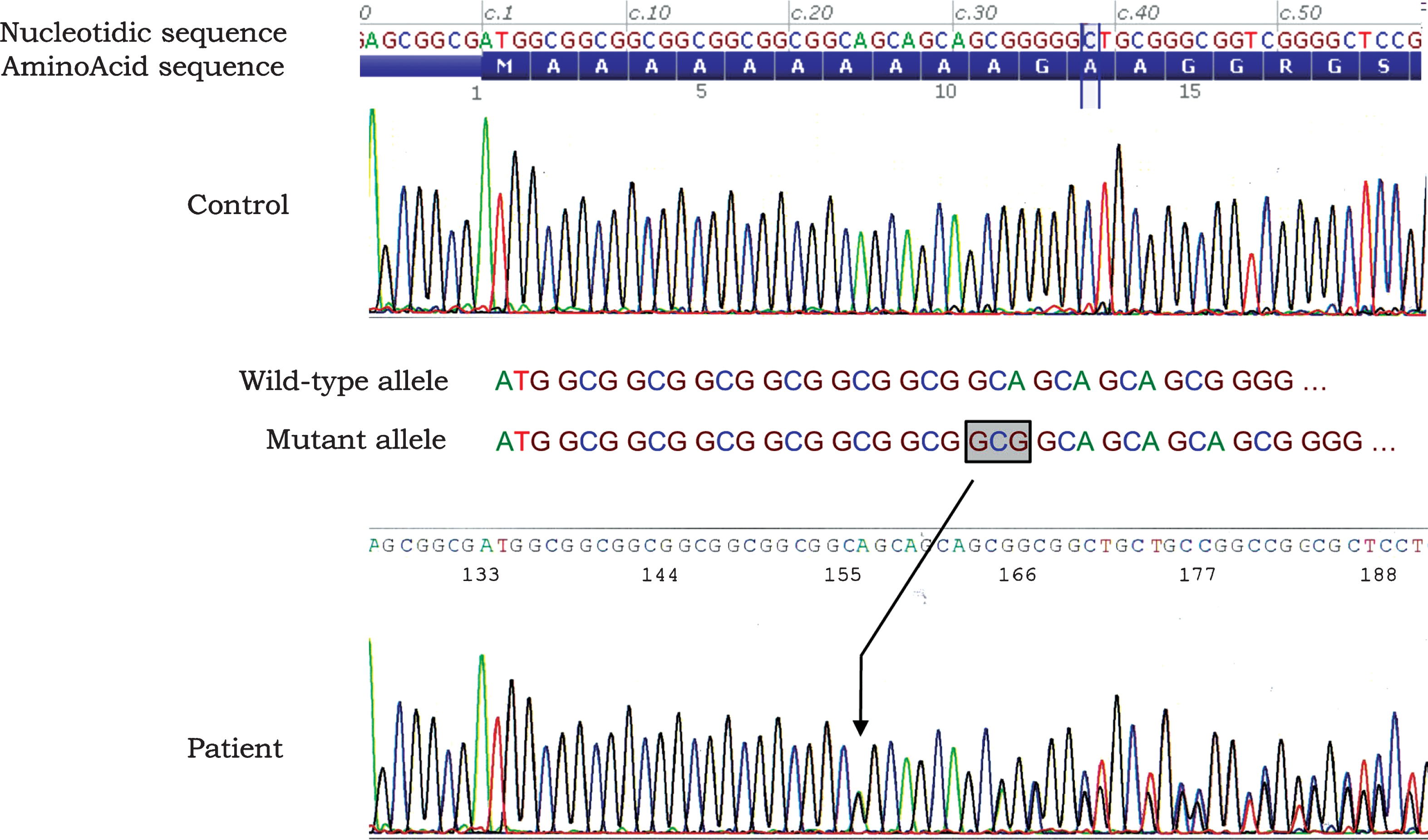 Electrophoregram of a partial sequence of exon 1 showing the expansion of a triplet (GCN). A simple schematic indicates the single GCG expansion in the mutated allele in the patient (surrounded text and black arrow). The absence of any other mutation that could explain the phenotype has been confirmed by full sequencing of the whole PABPN1 gene (data not shown).