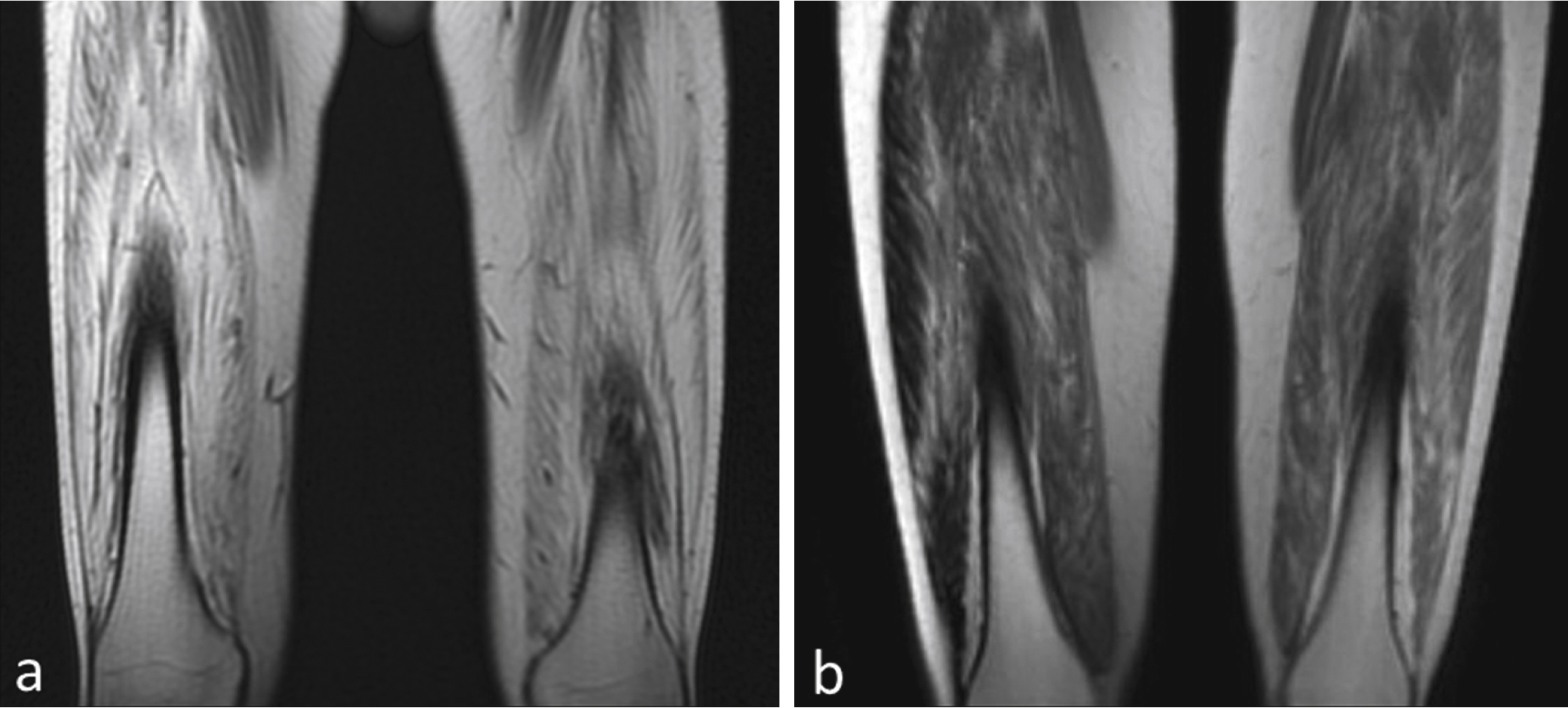 Degree of fibrosis correlates with treatment effect. (a) MRI of quadriceps muscles for the BMD patient with insignificant improvement (distance walked- 9 m on 6MWT) shows a much higher degree of skeletal muscle involvement compared to (b) the BMD subject who had most benefit (distance walked = 108 m on 6MWT).