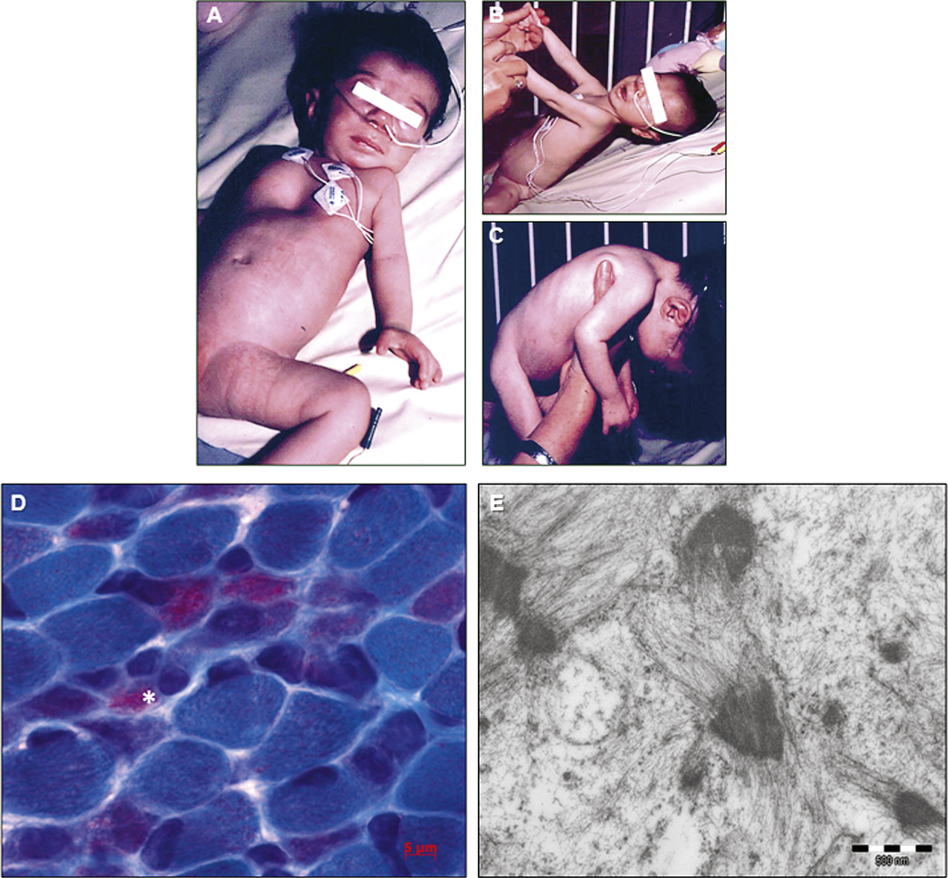 Clinical and histological features of the nemaline myopathy patient. A) Clinical examination of the patient revealed a floppy infant with pectus excavatum, and severely reduced active movements. B) The patient showed severe axial muscle weakness, and C) absence of antigravity reflexes, impossible neck extension or brief head control. D) Modified Engel-Gomori trichrome staining revealed the presence of marked fiber size variation, and the presence of nemaline bodies in 40-50% of fibers. The asterisk indicates a severely atrophic fiber filled by minirods.E) Electron microscopy confirmed the presence of small nemaline bodies (minirods).