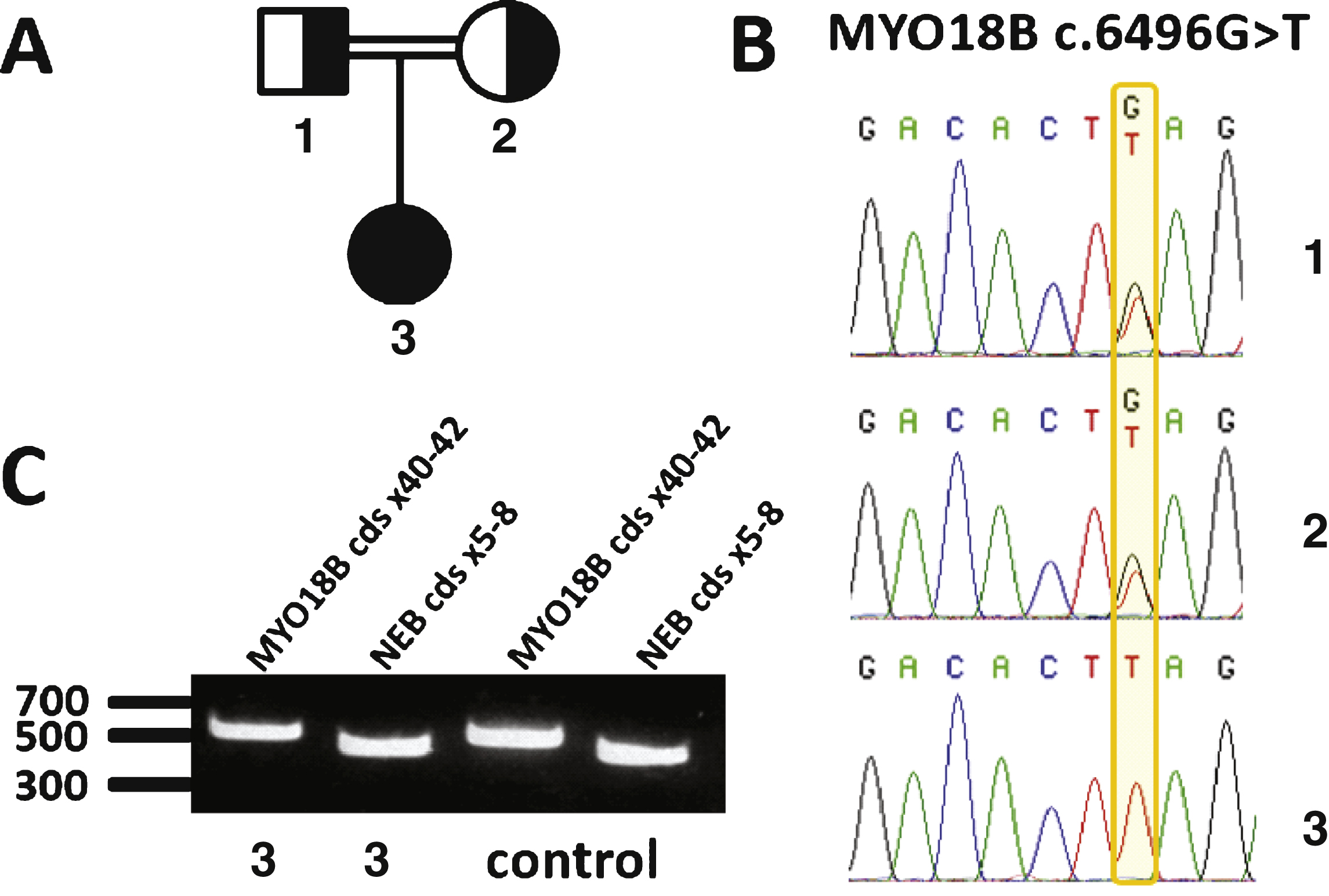Identification of a homozygous nonsense mutation in MYO18B. A) Pedigree of the consanguineous family. B) Chromatopherograms showing the segregation of the MYO18B c.6496G>T mutation. Both healthy parents (1 and 2) are heterozygous carriers of the MYO18B mutation; the patient (3) is homozygous. C) RT-PCR analysis of skeletal muscle cDNA. The MYO18B amplicon encompassing the MYO18B mutation was detected at comparable levels in the patient and an age-matched control. A NEB amplicon of similar size was used as internal control.