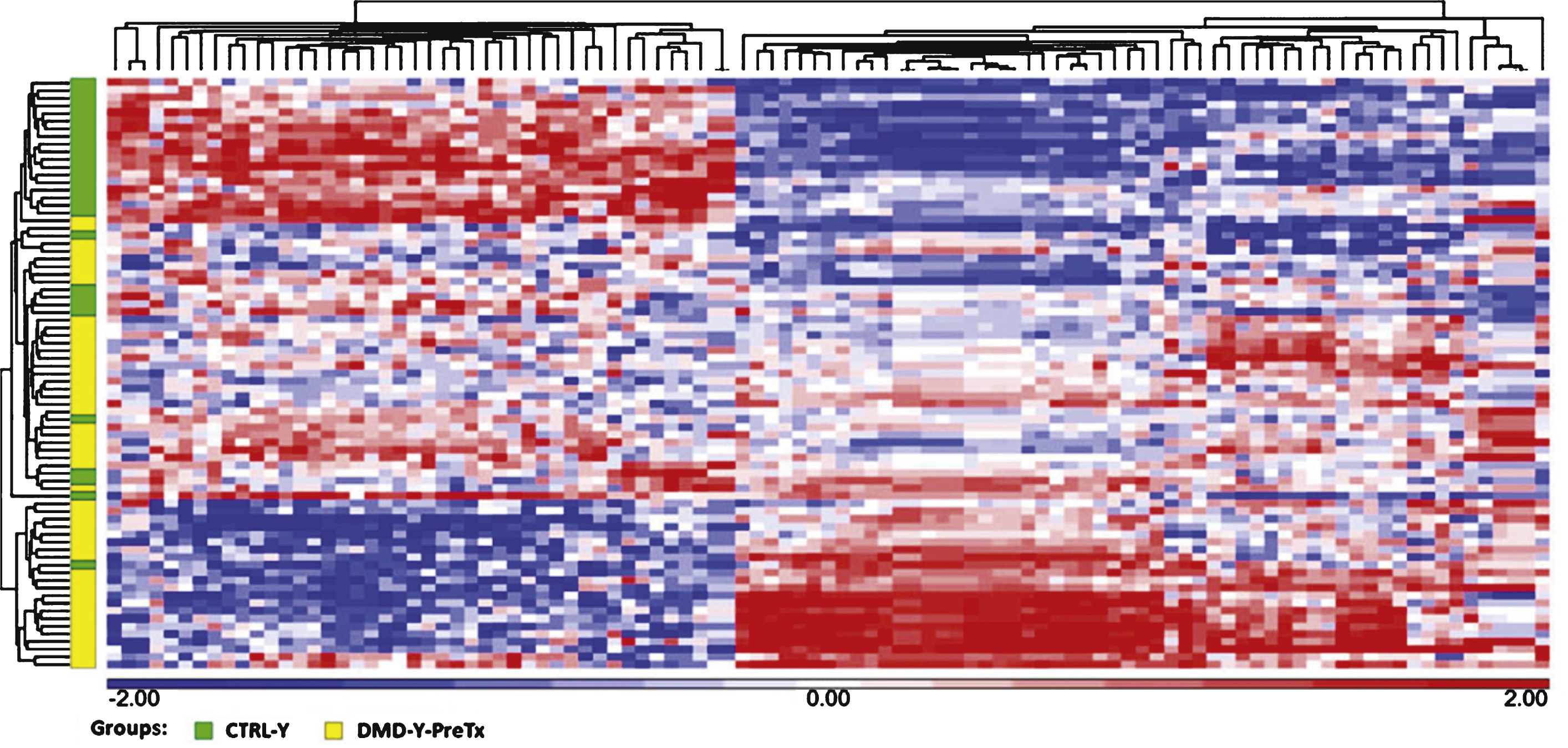 Hierarchical clustering of 101 mRNAs (FDR <0.05, fold change >  |1.2|) that were differentially expressed in the comparison of DMD-YpreTx (n = 49) and CTRL-Y (n = 28). Statistical differences were determined using unpaired t-test. Red = up-regulation; white = no change; blue = down-regulation.