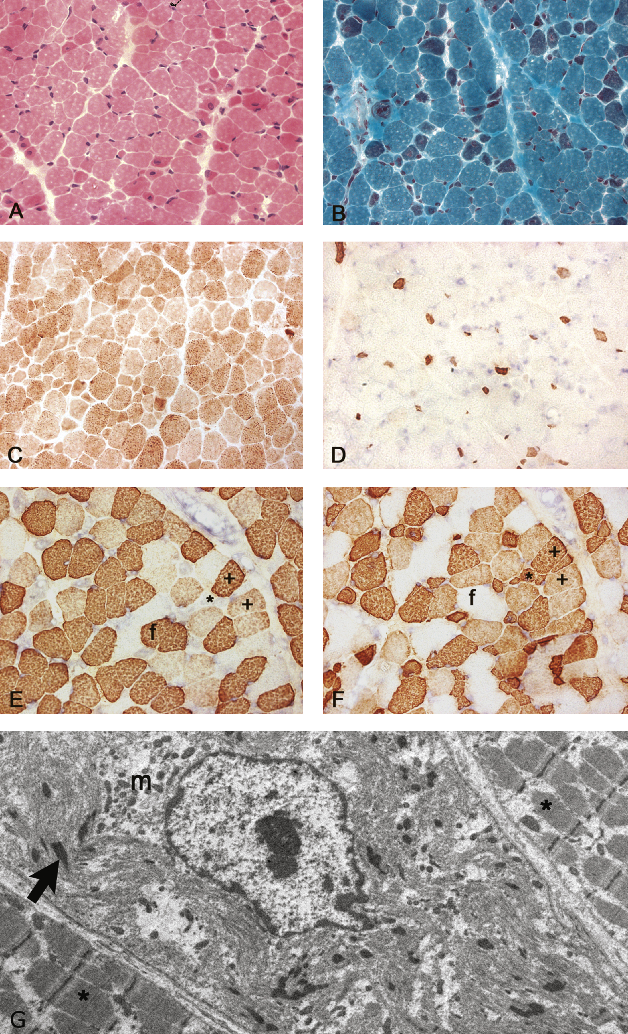 Histological stainings and immunolabelling of frozen sections and an electron micrograph of the muscle biopsy from the Proband. A) Haematoxylin and eosin staining showing a wide variation in fibre size with internal nuclei in several small fibres. Excess endomysial connective tissue or necrosis were not detected. B) Gömöri trichrome staining showing a population of small fibres containing red stained rods. C) Cytochrome C oxidase staining showing a population of darkly stained small type 1 fibres and some small weakly stained fibres. D) Immunolabelling with a monoclonal antibody to fetal myosin showing several very small positive fibres. E-F) Immunolabelling with monoclonal antibodies to fast (E) and slow (F) myosin heavy chains showing a population of small fibres that only express slow myosin (*), larger fibres that express fast (f) and several hybrid fibres with varying intensity that express both fast and slow myosin (+). G) Electron micrograph showing a fibre with severely disrupted myofibrils, an internal nucleus, small rods (arrow) and clusters of mitochondria (m), and less severely affected fibres either side (*) without rods.