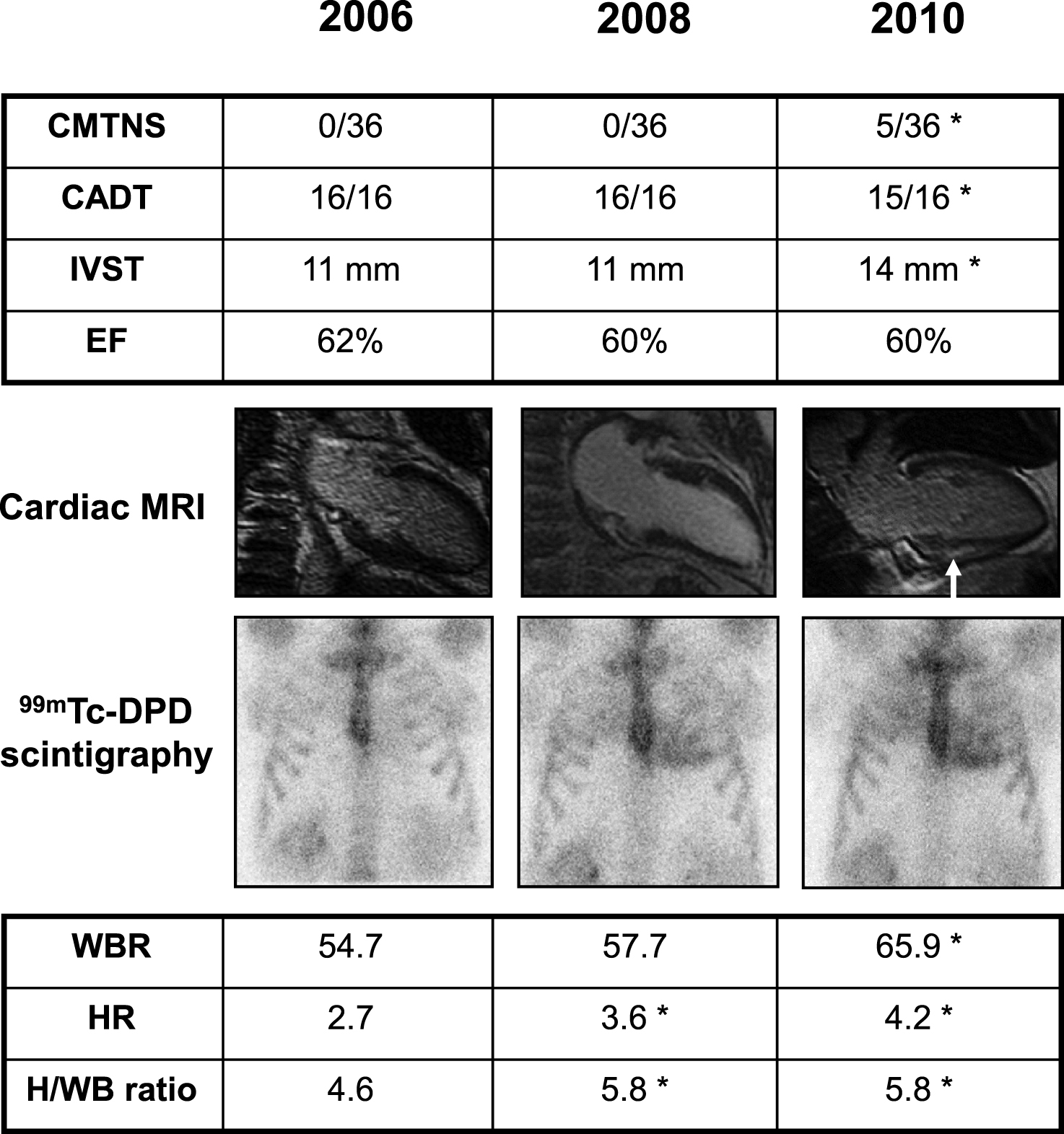 Clinical findings in an asymptomatic Glu89Gln carrier, showing higher sensitivity of 99mTc-DPD scintigraphy in detecting heart involvement. She was followed every two years with neurographic, autonomic and cardiological tests. Asterisk indicates a pathological result. At first control in 2006, at 46 years of age, Charcot-Marie-Tooth neuropathy score (CMTNS), compound autonomic dysfunction test (CADT), inter-ventricular septum thickness (IVST) and ejection fraction (EF) were normal; cardiac MRI and 99mTc-DPD scintigraphy were also normal; the latter showed no significant cardiac uptake (score 0) and normal indexes of semiquantitative analysis (HR, WBR, H/WB ratio; see Materials and Methods). In 2008, CMTNS, CADT, IVST, EF and cardiac MRI were still normal. On the contrary, 99mTc-DPD scan showed a mild cardiac uptake (score 1) confirmed by some pathological semiquantitative indexes. After two years, in 2010, there was a mild peripheral and autonomic nerve involvement at CMTNS and CADT, IVST was increased, cardiac MRI showed a minimal signal hyperintensity (arrow), and scintigraphy worsened to score 2.