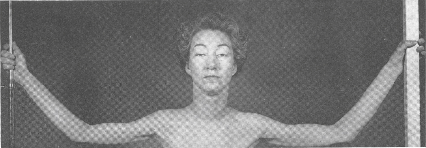 Bilateral ptosis and moderate atrophy of the shoulder girdle and arm muscles (figure reprinted with permission).