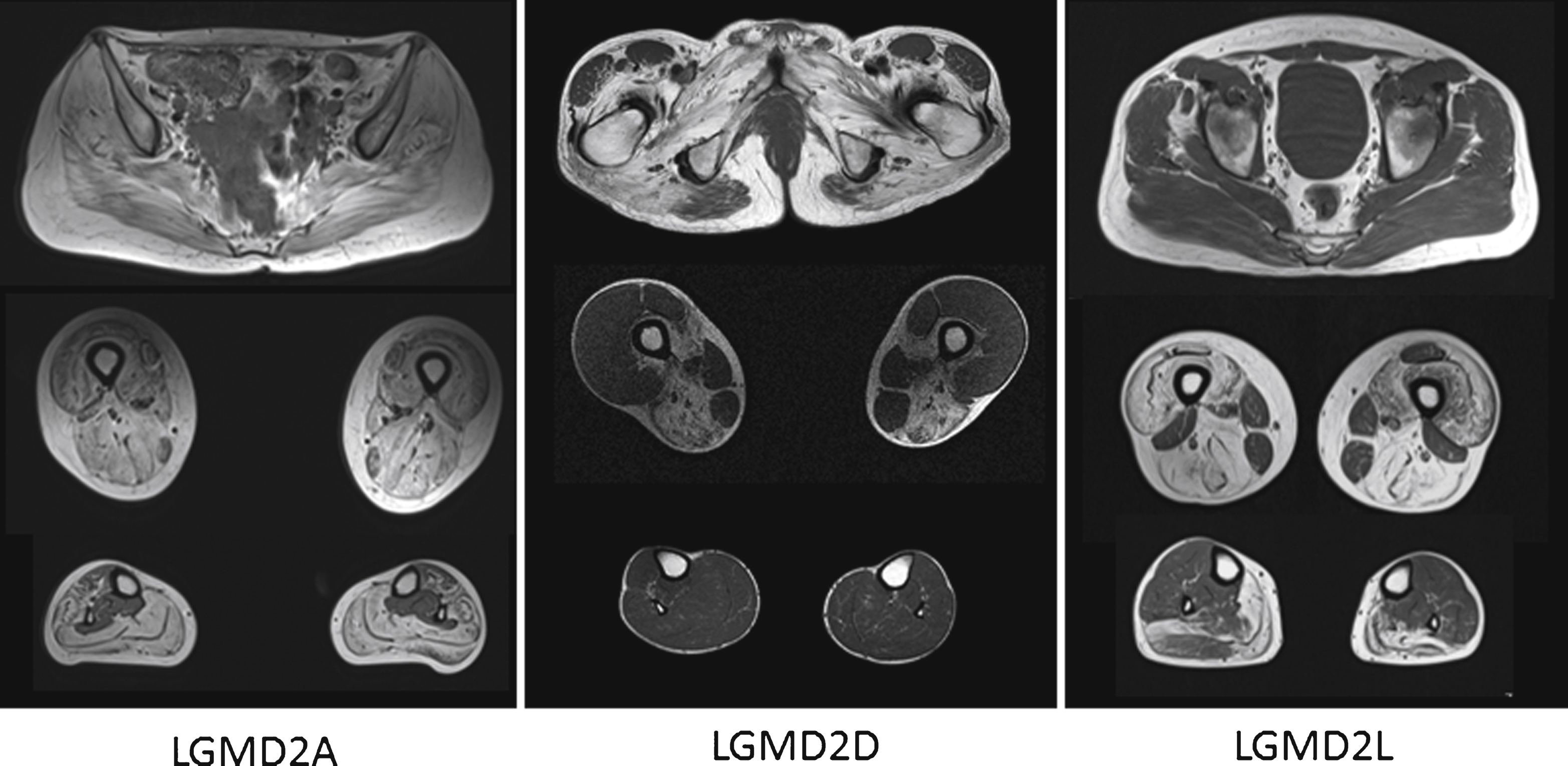 The images above show T1 weighted axial magnetic resonance images of the pelvic girdle and legs muscles of patients with LGMD2A, 2D and 2L. In all patients a selective pattern of muscle pathology can be seen, with advanced changes in the LGMD2A patient, well preserved calf muscles in the LGMD2D patients and well preserved gluteal muscles in the LGMD2L patient.