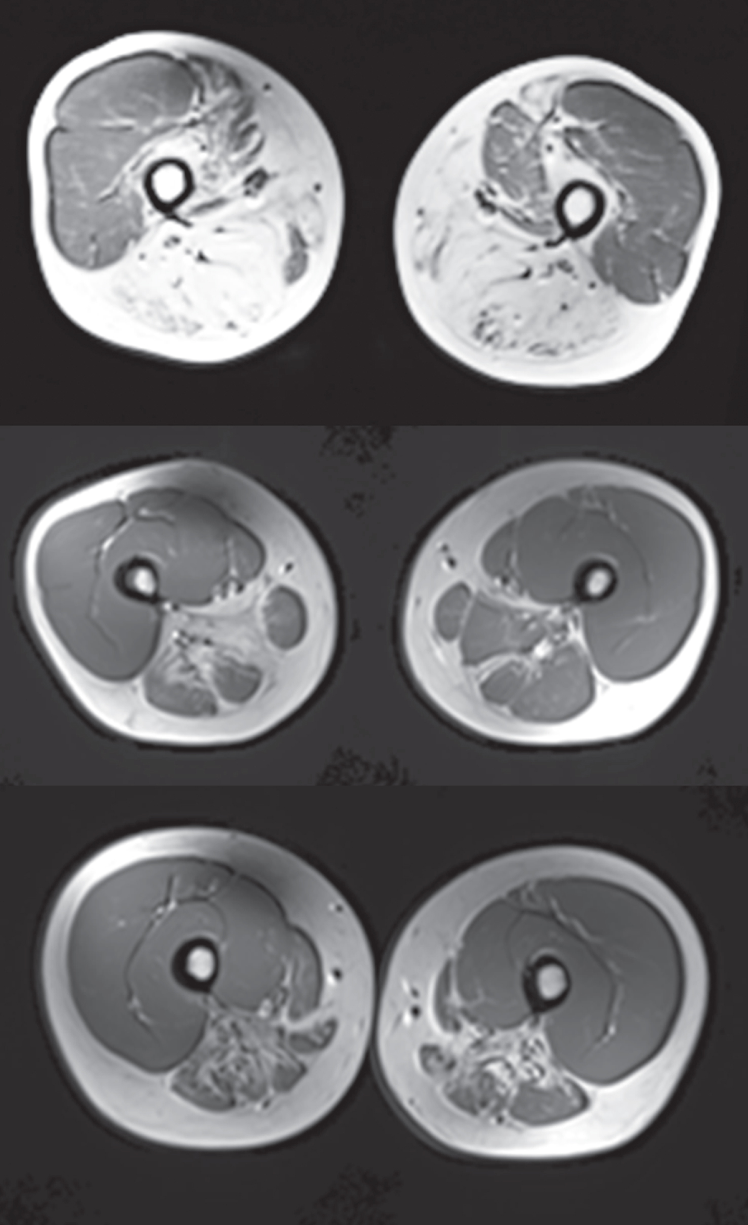 MRI (T1 weighted) Scans of Example Subject Lower Extremities Cross-sectional T1 weighted MRI scans of muscle groups of the upper leg of 3 selected GNEM subjects. The top panel shows the severity and specificity of destruction in the posterior compartment of the thigh compared with the quadriceps and had a score of 5. The two lower panels show substantial disease with scores in the 3 range. The mean scores for the key muscles in this posterior part of the thigh ranged from 3.8 to 4.1 for the overall population.