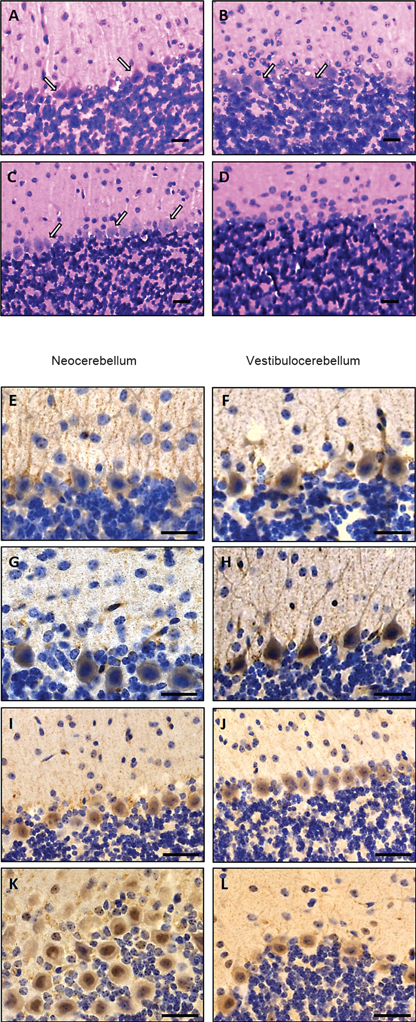 Cerebellar alterations in woozy mice. H&E: (A) Purkinje cell layer (white arrows) and absence of glial cell proliferation in a 6-week-old wild type littermate control. Scale bar = 20 μm. (B) Occasional mislocalisation of Purkinje-cells (white arrows) and proliferated (Bergmann) glial cells in a 6-week-old woozy mouse. Scale bar = 20 μm. (C) Purkinje-cell layer (white arrows) and absence of glial cell proliferation in a 26-week-old wild type littermate control. Scale bar = 20 μm. (D) Complete loss of Purkinje cells in a 26-week-old woozy animal. Scale bar = 15 μm. Immunohistochemistry: (E–L) Purkinje cells in the neo- and vestibulocerebellum of 6 weeks (E, G, I and K) and 26 weeks (F, H, J and L) old wildtype animals show enrichment of BCL2 in dendrites (E–H). Sil1-mutant Purkinje cells show decreased immunoreactivity in the neocerebellum (degenerating cells, G), but increased reactivity in Purkinje cells of the non-vulnerable vestibulocerebellum (surviving cells, H). (I–L) Investigation of PARP1 in Purkinje cells of woozy revealed increased immunoreactivity in the nuclei of neocerebellar Purkinje cells (K) but not in vestibulocerebellar Purkinje cells (L) compared to wildtype animals (I, J).