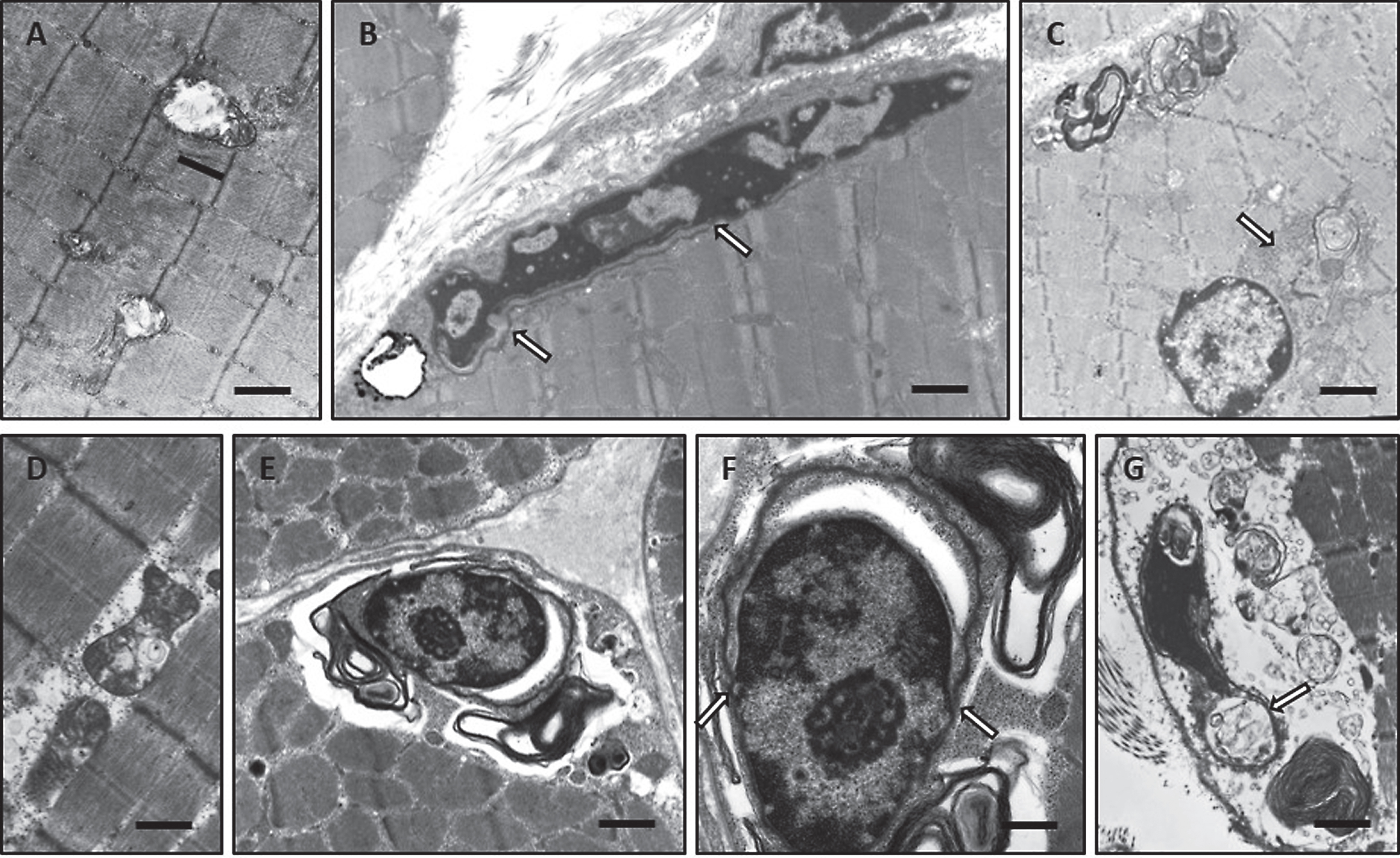 Ultrastructural alterations in woozy mouse quadriceps muscle at age of 26 weeks (A–C) and in genetically proven MSS-patients (D–G) analysed by transmission electron microscopy. (A) Disrupted intermyofibrillar mitochondria. Scale bar = 1.4 μm. (B) Pyknotic, degenerating myonucleus showing lift-off of the nuclear envelope (white arrows) specific for SIL1 deficiency. Scale bar = 1.3 μm. (C) Prominently widened and proliferated SR (white arrow) associated with autophagic material adjacent to a centralised myonucleus as well as accumulation of autophagic, myelin-like material in the sub-sarcolemmal space. Scale bar = 2.5 μm. (D) Disrupted intermyofibrillar mitochondria. Scale bar = 1 μm. (E) Degenerating myonucleus showing lift-off of the nuclear envelope surrounded by electron-dense myelin-like material most likely corresponding to protein aggregates. Scale bar = 1.7 μm. (F) Magnification of E highlighting the lamina fibrosa alteration specific for SIL1-deficiency (white arrows). Scale bar = 0.5 μm. (G) Pyknotic subsarcolemmal myonucleus with massive lift-off of the nuclear envelope (white arrow). Electron-dense myelin-like and granular material is detectable adjacent to the diseased myonucleus as well as within the irregular nuclear envelope loop. Scale bar = 1 μm.