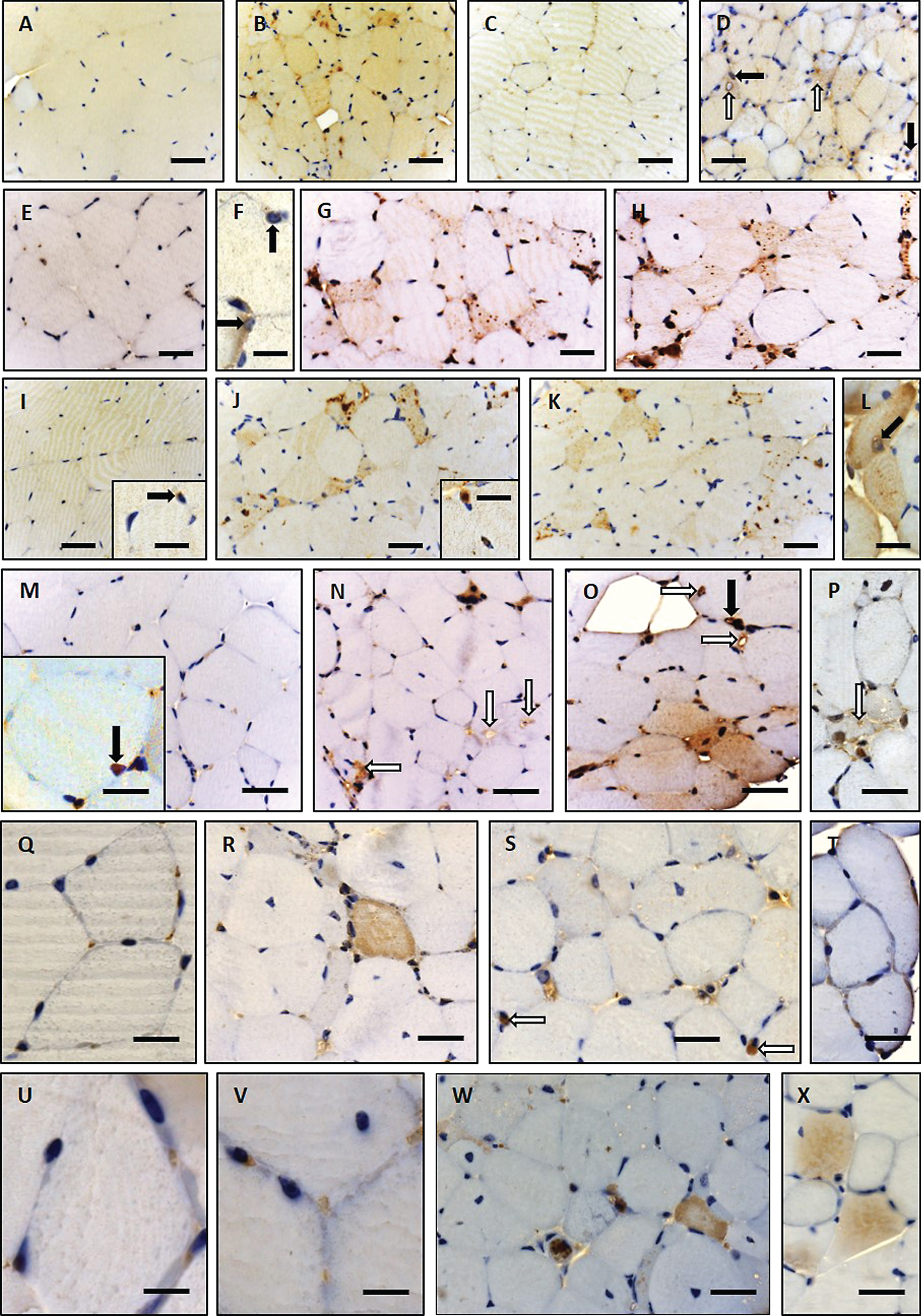 Immunohistochemistry of paraffin sections of paraformaldehyde-fixed quadriceps muscle specimens of 26-week-old wild type (A, C, E, F, I, M, Q and U) and woozy (B, D, G, H, J–L, N–P, R–T, V–X) animals: (A) weak creatine kinase (muscular) immunoreactivity of the sarcoplasm in wild type mouse muscle fibres. Scale bar = 22 μm. (B) Muscle fibres of normal size and especially partially atrophic muscle fibres showing increased muscle creatine kinase immunoreactivity. Scale bar = 19 μm. (C) Minor DJ-1 immunoreactivity of wild type mouse muscle and enhanced diffuse as well as perinuclear (black arrows) and vacuole-associated (white arrows) DJ-1 immunoreactivity in Sil1-mutant muscle fibres (D). Scale bars = 20 μm. (E) Minor diffuse immunoreactivity for the SIL1 binding partner BiP in wild type mouse muscle fibres is showing a sarcomeric pattern which probably corresponds to a labelling of the SR. Scale bar = 22 μm. (F) BiP immunoreactivity associated with myonuclei/ nuclear envelope (black arrows) in mouse wild type muscle fibres. Scale bar = 10 μm. (G and H) Partially atrophic and atrophic muscle fibres of a woozy animal show strong BiP immunoreactivity of subsarcolemmal and intermyofibrillar deposits, some of which are associated with vacuoles and myonuclei. Scale bars = 22 μm. (I) Diffuse immunoreactivity of TDP-43 within the sarcoplasm and occasionally in myonuclei (inset in I) of muscle fibres derived from wild type animals. Scale bar = 22 μm; in inset 10 μm. (J–L) In this woozy mouse muscle specimen, enhanced intermyofibrillär punctuate TDP-43 immunoreactivity is accompanied by prominent labelling of the perinuclear region and nuclear membrane (inset in J and L). Scale bars in J and K = 22 μm; inset in J = 10 μm and L = 15 μm. (M) Nuclear labelling after incubation with the LAP2 antibody in wild type mouse muscle. Scale bars in M = 22 μm, in inset = 10 μm. (N–P) Prominent LAP2 immunoreactivity of the abnormal vacuoles (white arrows) and of the sarcoplasm of woozy muscle fibres. Scale bars in N = 25 μm, in O = 22 μm, in P = 19 μm. (Q) Myonuclei with weak Emerin immunoreactivity in wild type muscle fibres. Scale bar = 10 μm. (R, S) Prominent immunoreactivity for Emerin in dystrophic muscle fibres (sarcoplasmic staining) and adjacent to myonuclei (white arrows). Scale bars = 19 μm. (T) Irregular Emerin immunoreactivity of the sub-sarcolemmal region. Scale bars in R and S = 20 μm, in T = 17 μm. (U) Myonuclei with very weak Lamin A/C immunoreactivity in wild type muscle fibres. Scale bar = 6 μm. (V) Prominent immunoreactivity for Lamin A/C adjacent to myonuclei and (W, X) in lesioned muscle fibres (sarcoplasmic staining). Scale bars in V = 6 μm, in W and X = 25 μm.
