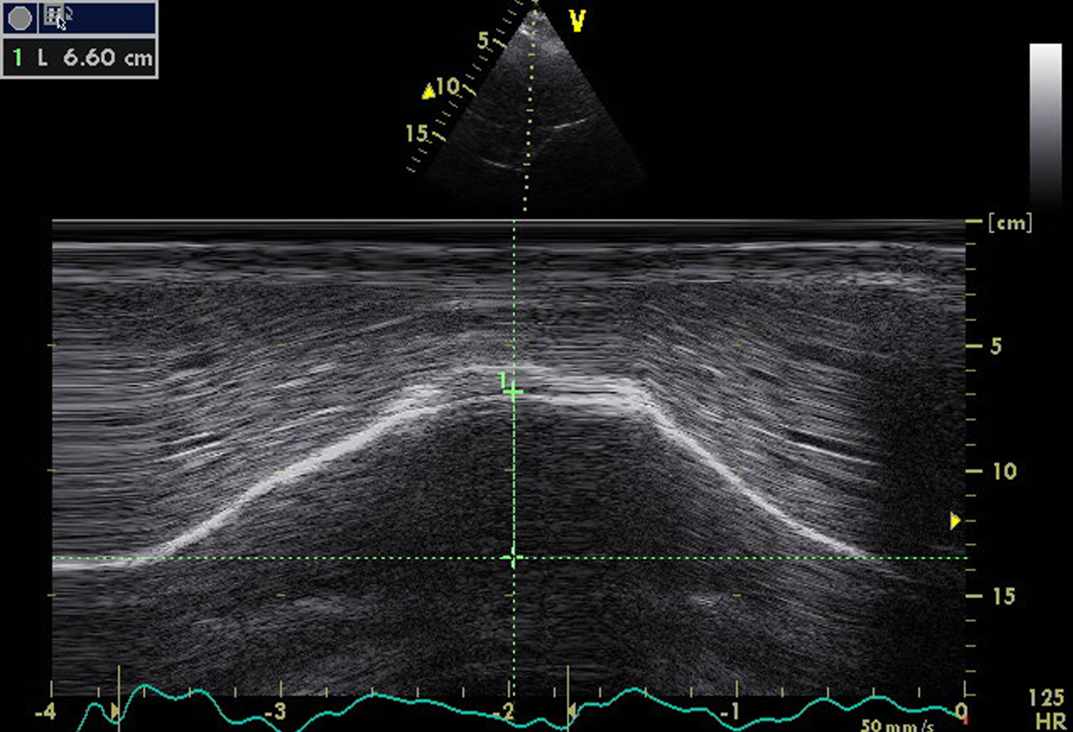 Diaphragm M mode ultrasound imaging from an anterior subcostal view for the measurement of the hemi diaphragm motion during inspiration. Note the normal right hemi-diaphragmatic excursion reaching 66 mm during deep inspiration.