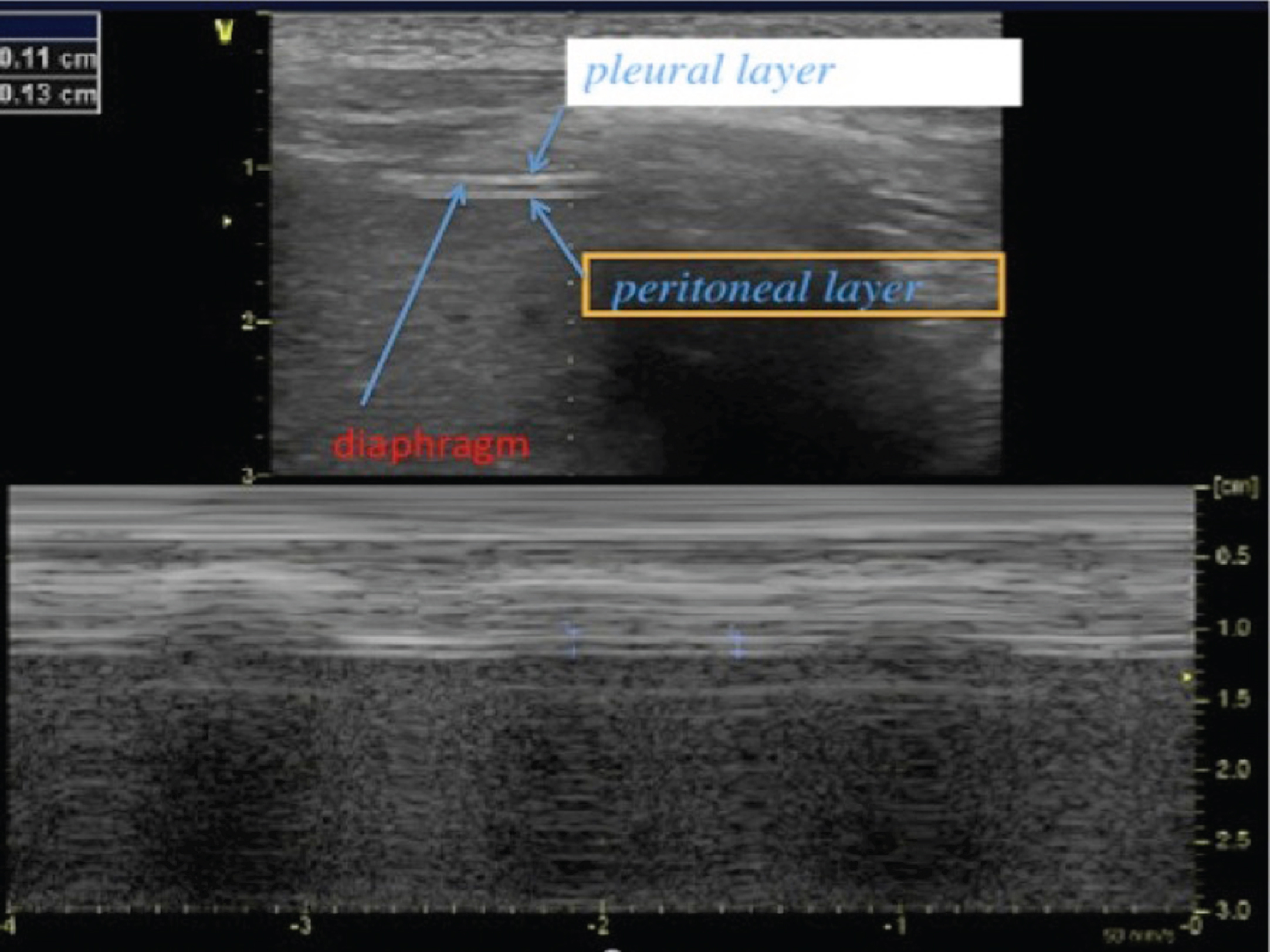 2D mode ultrasound imaging from the zone of apposition for the measurement of diaphragm thickness. The diaphragm is located beneath the intercostal muscles and we can distinguish three layers: a hypo-echogenic thick layer (diaphragm muscle) surrounded by two hyper-echogenic lines (pleural layer and peritoneal layer). Here is a reduced diaphragm thickness (1.3 mm) in a patient with Duchenne muscular dystrophy.