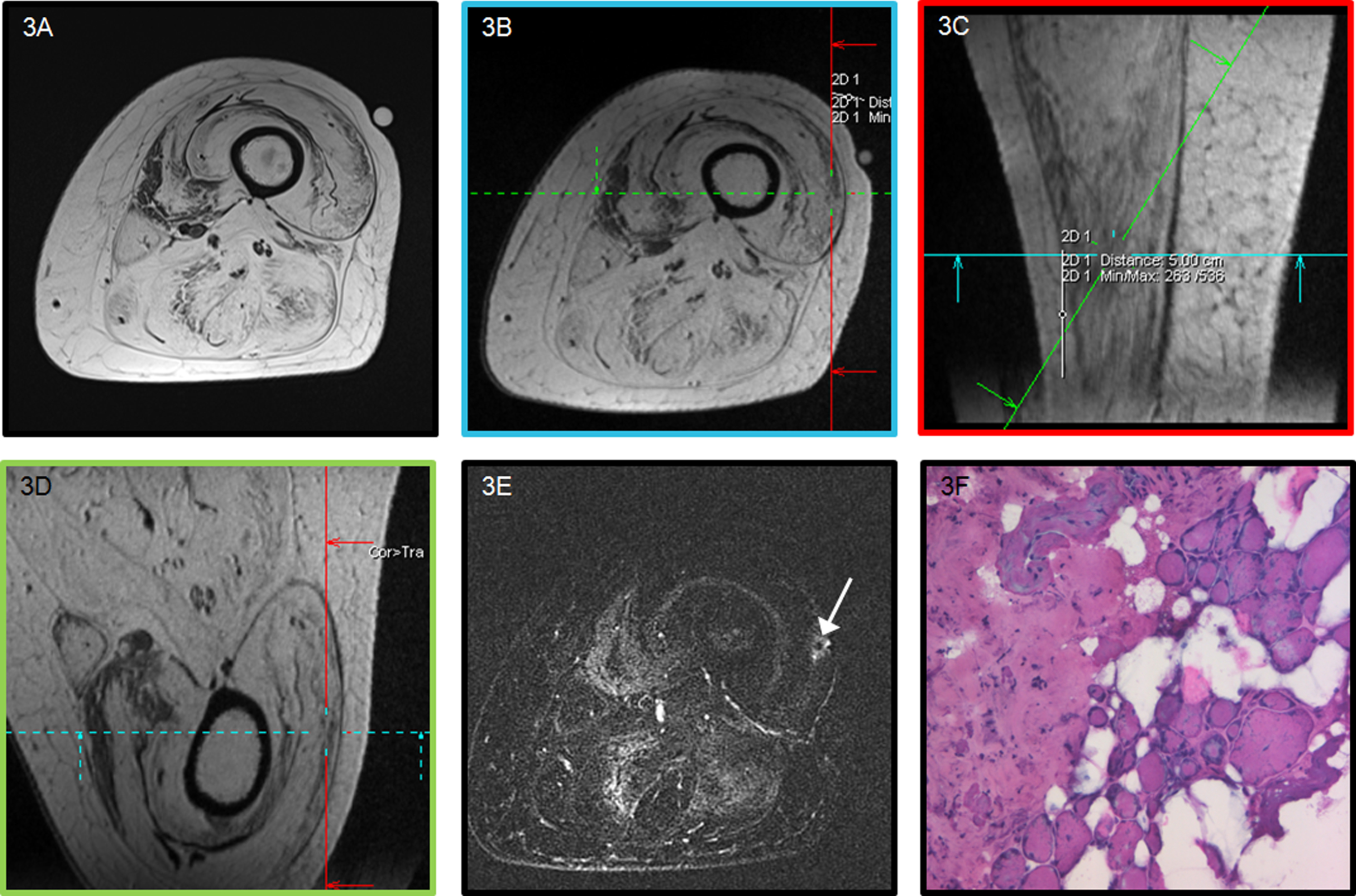 MRI-guided muscle biopsy in a patient with limited residual muscle tissue. (A) Axial T1-weighted axial image of the left upper leg of a 49-year-old female FSHD1 patient showing marked fatty infiltration of all muscles. (B-D) 3D T1 planning images to determine the appropriate needle trajectory to the target site. Colored boxes surrounding the images correspond with colored lines indicating images planes. (E) post-biopsy TIRM image showing the biopsy site (arrow). (F) H-Phlox staining demonstrates severe dystrophic changes as reflected by the marked increase in fiber size variability, increased internal nuclei, fibrosis, and fatty infiltration.