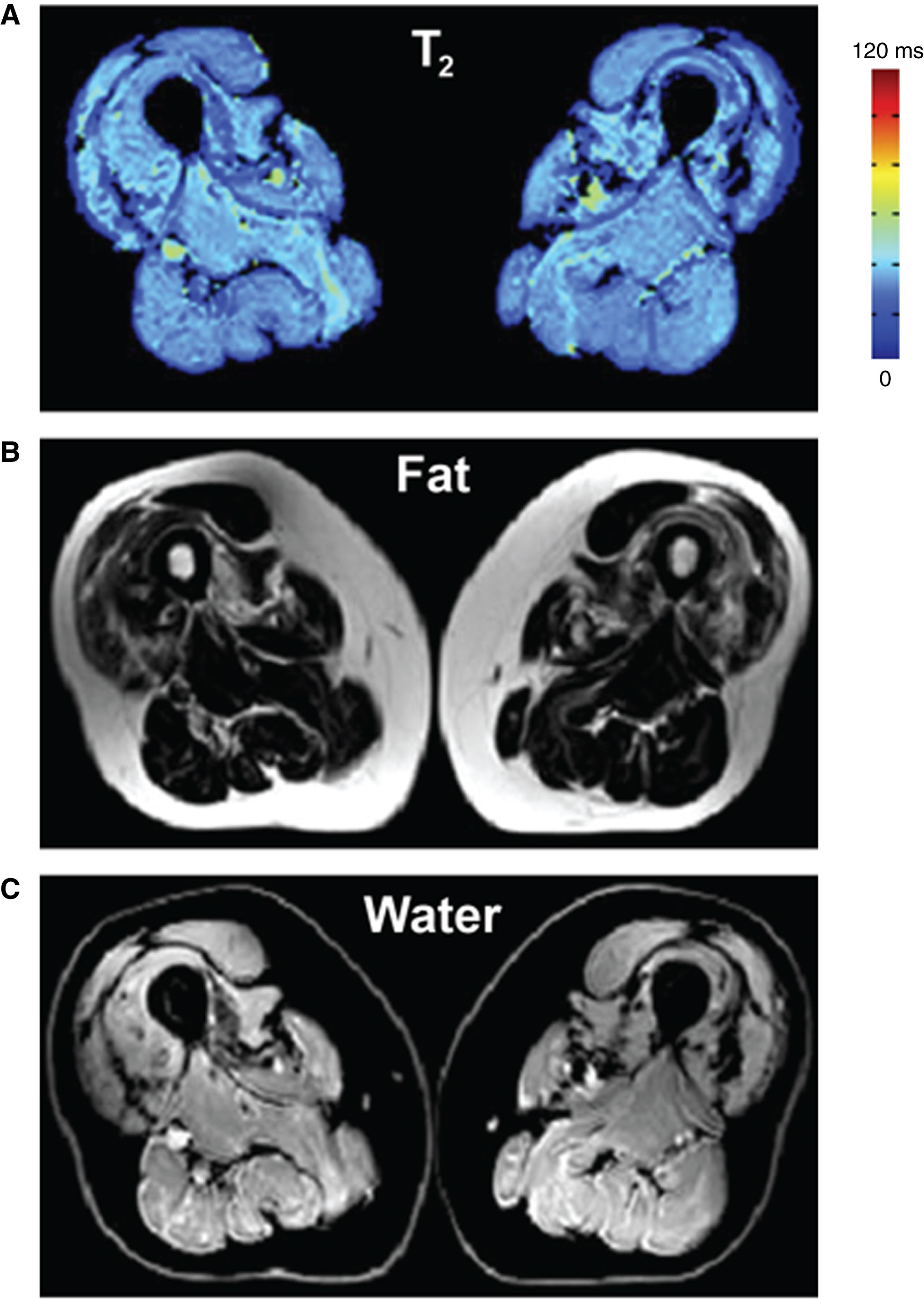 Bi-component extended phase graph (EPG) approach to simultaneously quantify the muscle water T2 and fat fraction. (A) Water T2 map. (B) Fat image. (C) Water image. Figure adapted from Marty et al. with permission [32].