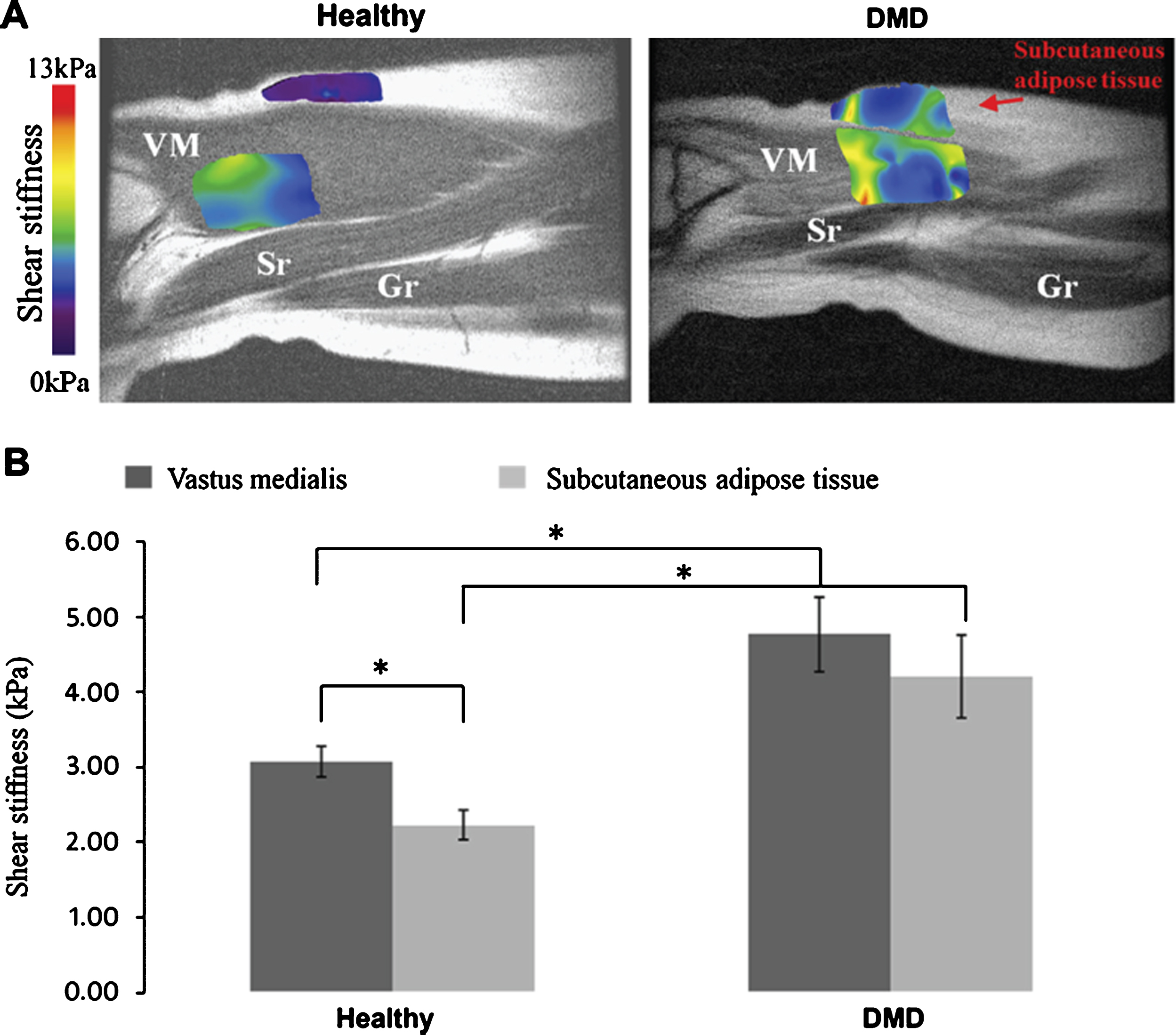 Biomechanical characterization of skeletal muscle in DMD children. (A) MR Elastography derived sheer stiffness color maps projected on parts of the legs of a healthy subject and a child with DMD. VM = vastus medialis, Sr = sartorius, Gr = gracilis. (B) Quantification of the shear stiffness in the vastus medialis and the subcutaneous adipose tissue (* = P < 0.1). Figure reproduced with permission from Ref. [100].