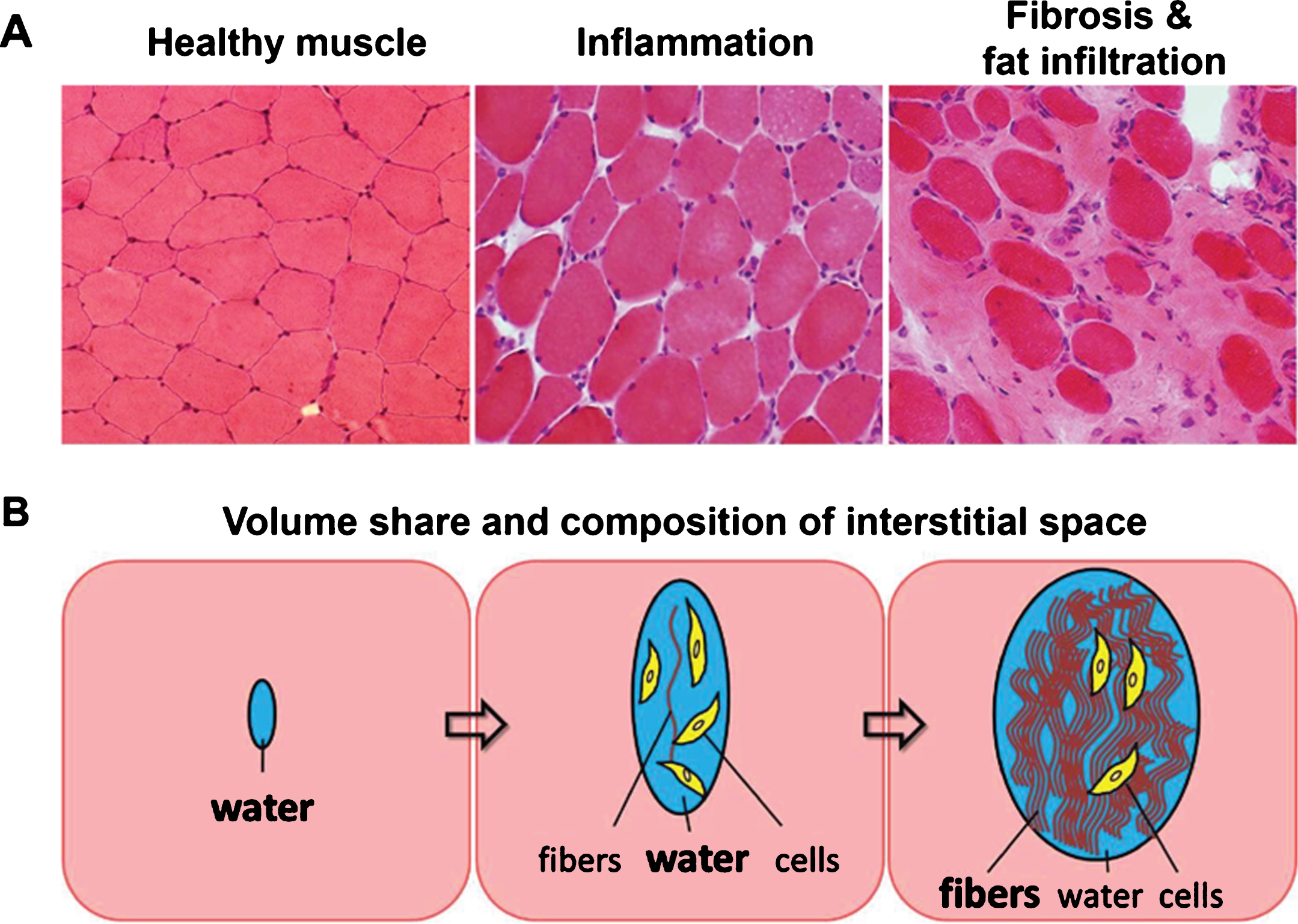 (A) Histological sections of healthy muscle, inflamed muscle, and heavily fat infiltrated and fibrotic muscle tissue. (B) Schematic of changes in volume share and composition of the interstitial space due to inflammation and as a consequence of fibrosis and fat infiltration.