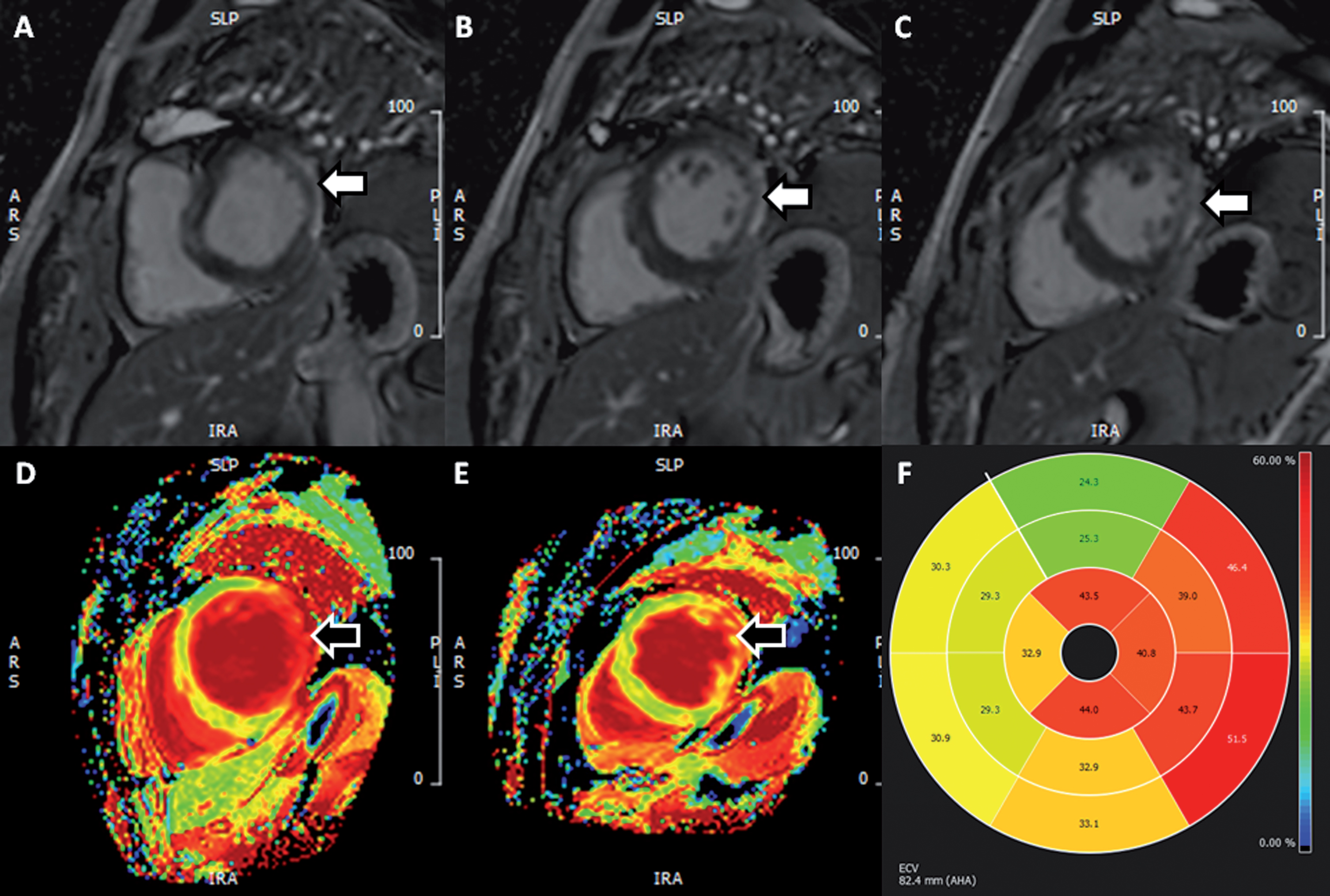 Presence of scar in 53-year old man with myotonic dystrophy type 1. (A-C) Sequential basal and mid-ventricular slices in short-axis from LGE images demonstrating dense subepicardial scar in the left ventricular lateral wall (white arrows). (D-E) Matching basal and mid-ventricular ECV maps providing a qualitative impression of expanded extracellular space in this region (black arrows). (F) Polar plot of segmental ECV values – normal range 20–30%. Here we see significant elevations in ECV, not only in regions of dense scar (lateral wall) but also in the septal and inferior segments, suggesting the presence of diffuse fibrosis in these (LGE-free) segments. (LGE, late gadolinium enhancement; ECV, extracellular volume). Permission for submission granted.