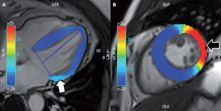 (same patient as Fig. 1). CMR tissue tracking. (A) Longitudinal strain map in 4-chamber view cine demonstrating a reduction in regional longitudinal strain in the basal lateral wall, of – 10% (white arrow; normal values around – 20%). (B) Circumferential strain map of mid-ventricular short-axis cine demonstrating a more obvious reduction in deformation of around +10% (black arrow; normal values around – 20%). (CMR, cardiac magnetic resonance). Permission for submission granted.