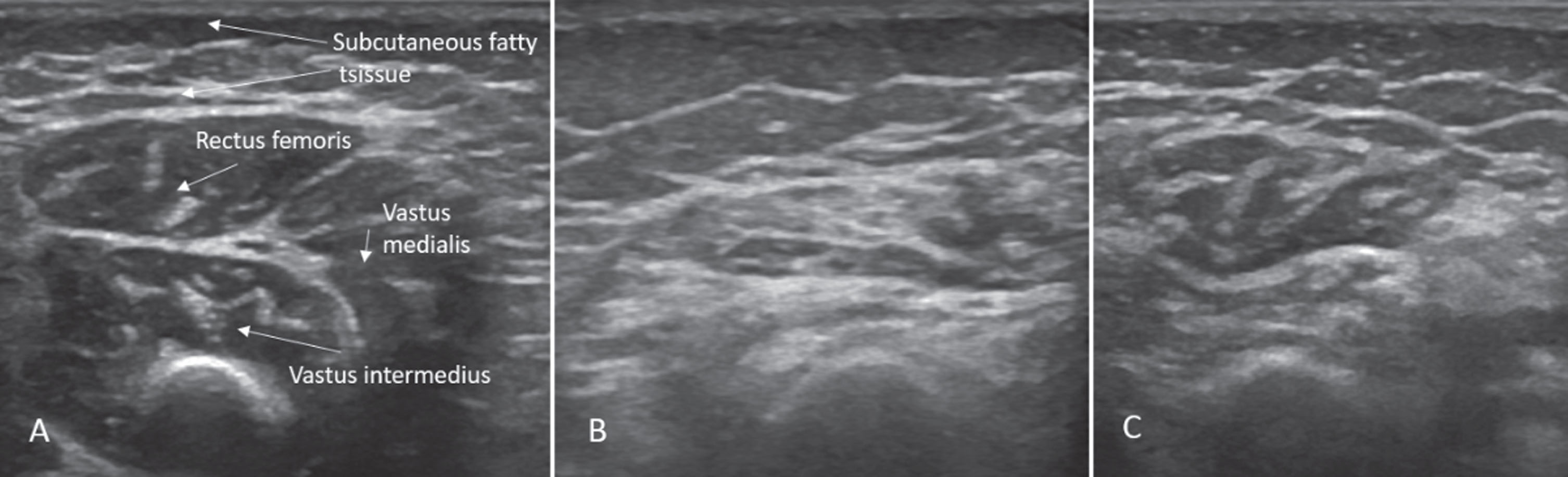 Sonographic findings of quadriceps in case 1: (A) Age 2 months: normal echogenicity and clearly visible internal septa. (B) Age 14 months, 6 months after onset of disease: a pathologic increase in background echogenicity in comparison to subcutaneous fat tissue and less definable intramuscular septa. (C) Age 17 months, after 8 months of nusinersen therapy: partial recovery with increase in volume and normalisation of echogenicity in the rectus femoris.