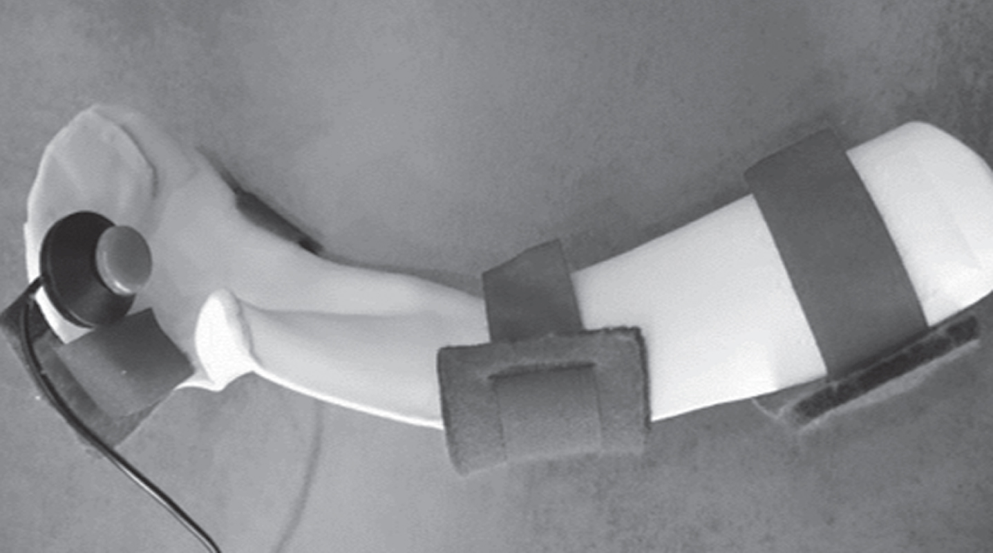 Volar view of an orthosis with integrated alarm button.