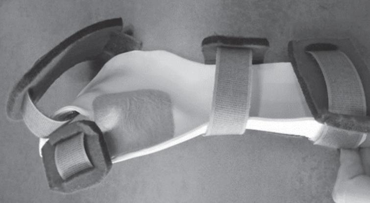 Dorsal view of an orthosis with additional padding near the web space.