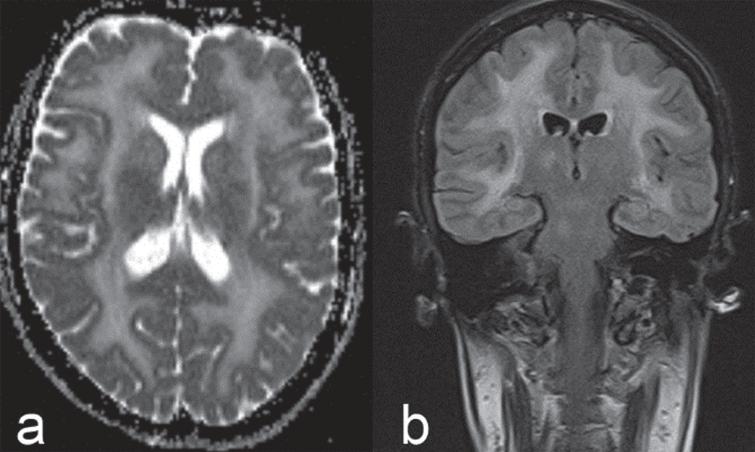 Brain MRI in adult LAMA2-MD: axial T2 diffusion (a) and coronal FLAIR (b) images showing confluent, mostly supra-, but also infratentorial white matter signal changes.