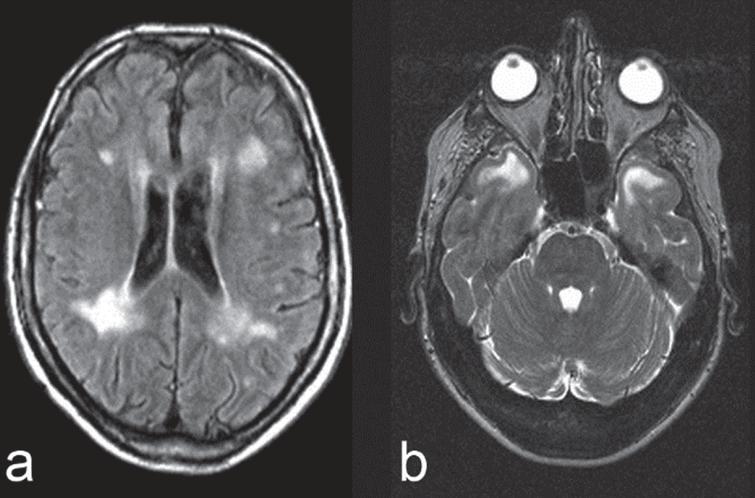 1.5 T brain MRI in DM1, FLAIR sequences. a) 41-year-old adult-onset male DM1 patient with moderate confluent periventricular and mild subcortical white matter lesions. b) 47-year-old adult-onset female DM1 patient with bilateral anterior temporal white matter lesions (ATWML) and marked thickening of the skull [87].