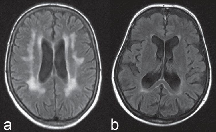 1.5 T brain MRI in DM2, FLAIR sequences. a) 68-year-old female DM2 patient with severe confluent periventricular white matter lesions and general moderate brain atrophy. Cerebrovascular risk factors like hypertension or diabetes were not present. b) 65-year-old female DM2 patient with general brain atrophy [87].