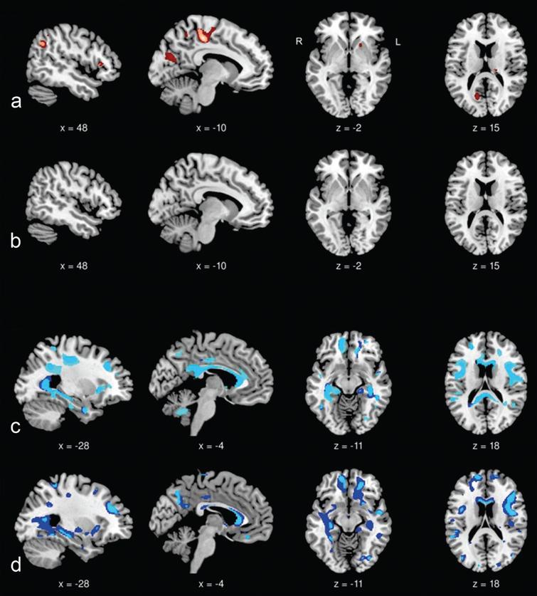 3.0 T brain MRI, voxel-based morphometry (VBM) in DM1 and DM2. Longitudinal MRI data at baseline and follow-up after 5.5±0.4 years. Group comparisons at baseline and follow-up. Displayed results of VBM analyses are based on a threshold of pfalse discovery rate < 0.05 at voxel-level with an extended cluster threshold of 10 voxels. The coordinates refer to the MNI reference space. VBM analyses were performed in 13 DM1, 15 DM2 patients, and 13 controls. (a) Grey matter decrease in DM1 patients compared with controls at baseline (light red) and at follow-up (light and dark red). Dark red areas had not been affected at baseline. (b) Grey matter decrease in DM2 patients compared with controls at baseline and at follow-up (no clusters detected). (c) White matter decrease in DM1 patients compared with controls at baseline (light blue) and at follow-up (light and dark blue). (d) White matter decrease in DM2 patients compared with controls at baseline (light blue) and at follow-up (light and dark blue). Dark blue areas had not been affected at baseline [72].