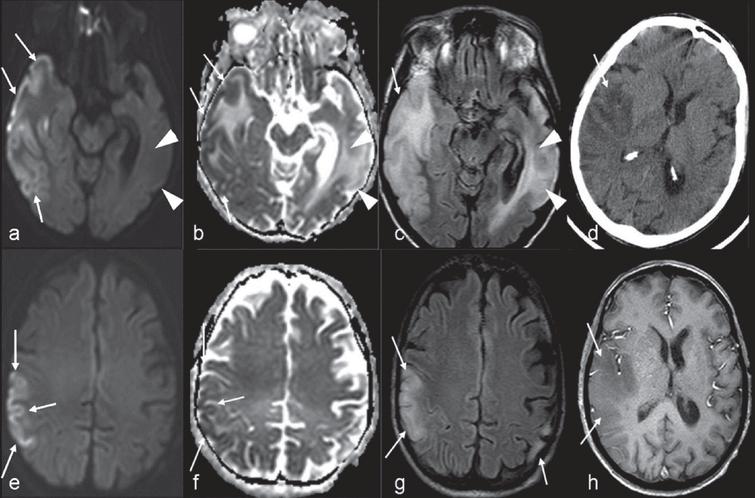 1.5 T brain MRI. A 53-year-old female patient with MELAS and multiple stroke-like lesions showing an encephalopathic episode with epileptic seizures, mild left-sided hemiparesis, and dysarthria since 1 week: Diffusion-weighted (a, e) images with corresponding ADC maps (b, f) show restricted diffusion in the right temporal cortex (arrows). ADC maps are indicative of mixed cytotoxic and vasogenic edema in these areas (b, f; arrows). Additional non-acute lesions are demonstrated in FLAIR (c, g; arrowheads) and ADC maps (b, f; arrowheads) in the left temporal lobe. Unenhanced CT (d) shows no calcification and no hemorrhage. There is no enhancement on T1-weighted post-contrast image (h; arrows) [161].