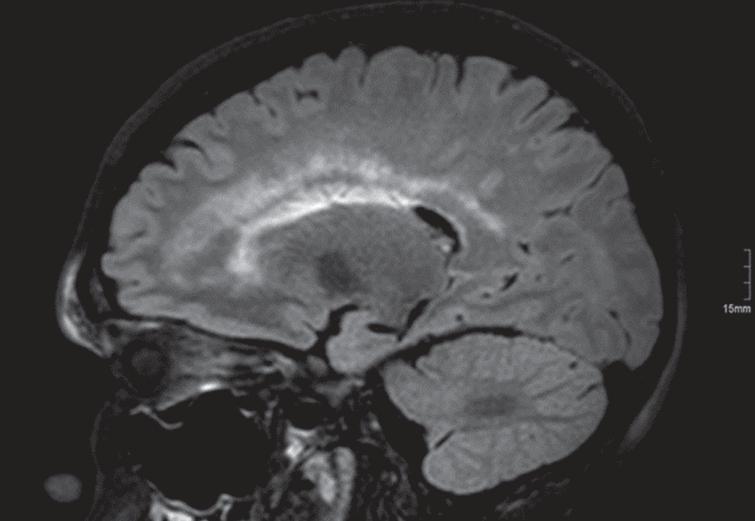 1.5 T brain MRI, FLAIR sequences. A 25-year-old male patient with mitochondrial neurogastrointestinal encephalomyopathy (MNGIE) harbouring two pathogenic heterozygeous TYMP mutations.