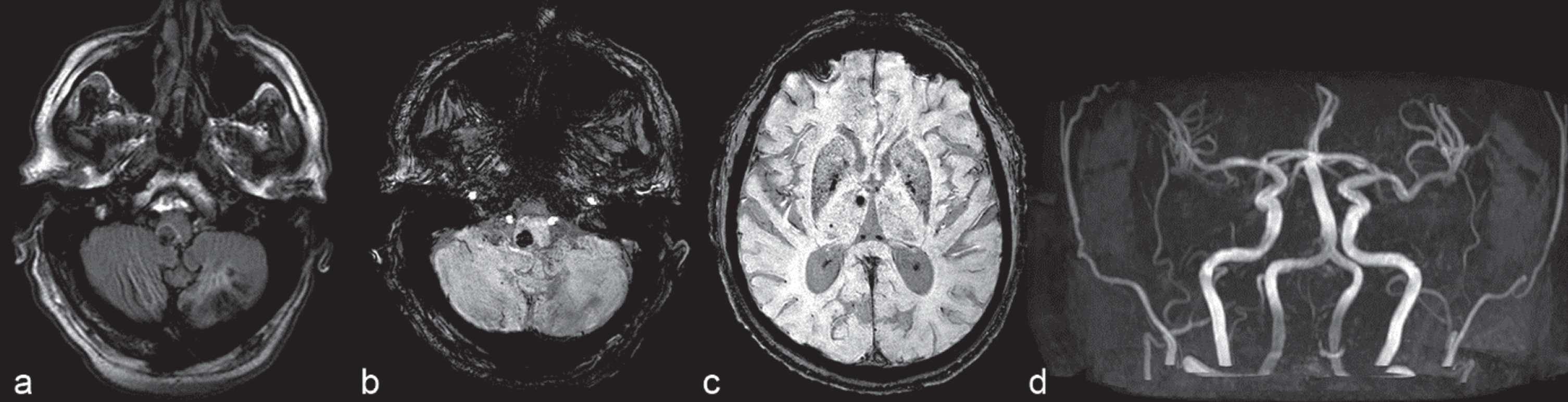 3.0 T brain MRI. 61-year-old male late-onset Pompe disease patient harbouring two pathogenic heterozygous GAA mutations, enzyme replacement therapy with glucosidase alfa since 9 years. a) FLAIR sequences. Subacute paramedian pontine hemorrhage, chronic ischemic stroke lesion affecting the left cerebellar hemisphere. b) Susceptibility-weighted images (SWI). Subacute paramedian pontine hemorrhage, mild ectasia of the basilar artery and dilative angiopathy of vertebral arteries, chronic ischemic stroke lesion affecting the left cerebellar hemisphere. c) Susceptibility-weighted images (SWI). Multiple microbleeds presenting predominantly as vertebrobasilar circulation disorder. d) MR angiography shows mild ectasia of the basilar artery and dilative angiopathy of vertebral arteries.