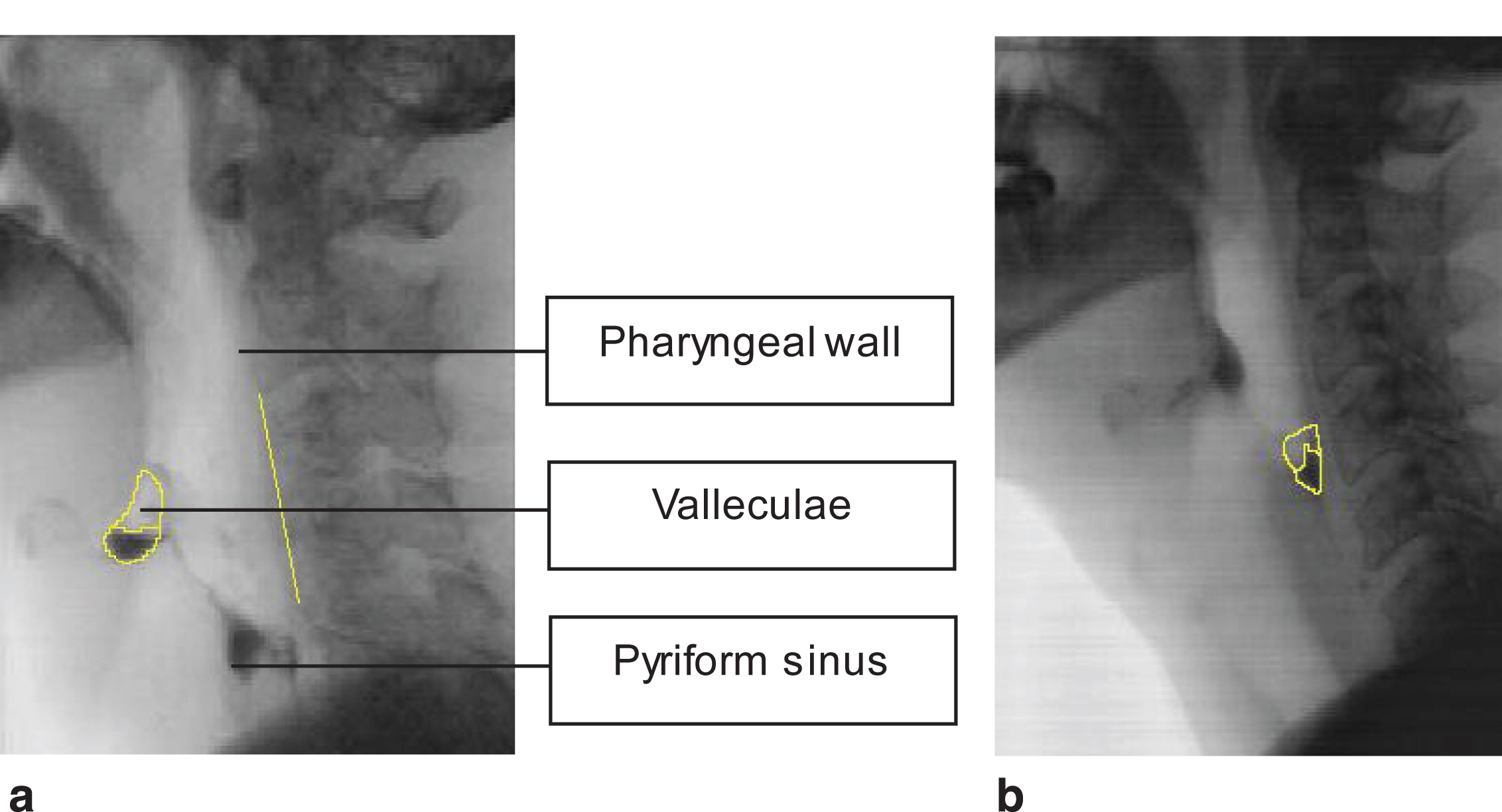 a. Post swallow residue in the valleculae and the scalar reference line from C2 to C4. b. Post swallow residue in the pyriform sinus.