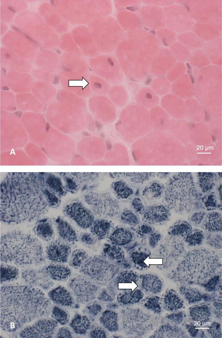 Muscle biopsy of patient 5. A: HE staining showing an increase in centralized myonuclei (⇒). B: NADH staining showing pale peripheral halos (⇒) and increased central enzyme activity (⇐).
