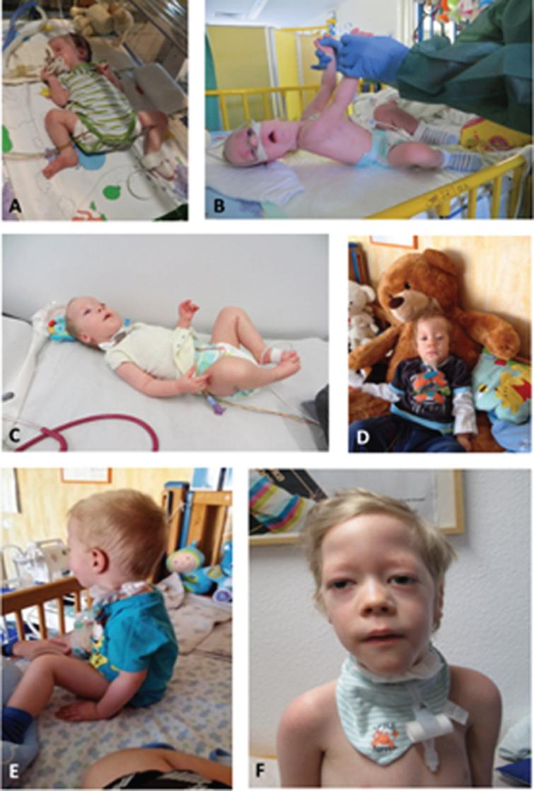 Patient 7. A: At age of 1 month: presenting as floppy infant with legs in frog position. B: At age of 3 months: showing lack of head control and typical appearance with long forehead. C: At age of 6 months: first signs of motility and power in lower limbs and forearms. D: At age of 10 months: able to sit with support only when placed. E: At age of 22 months: able to sit independently and showing full head control. F: At age of 6 years (permission granted by parents).