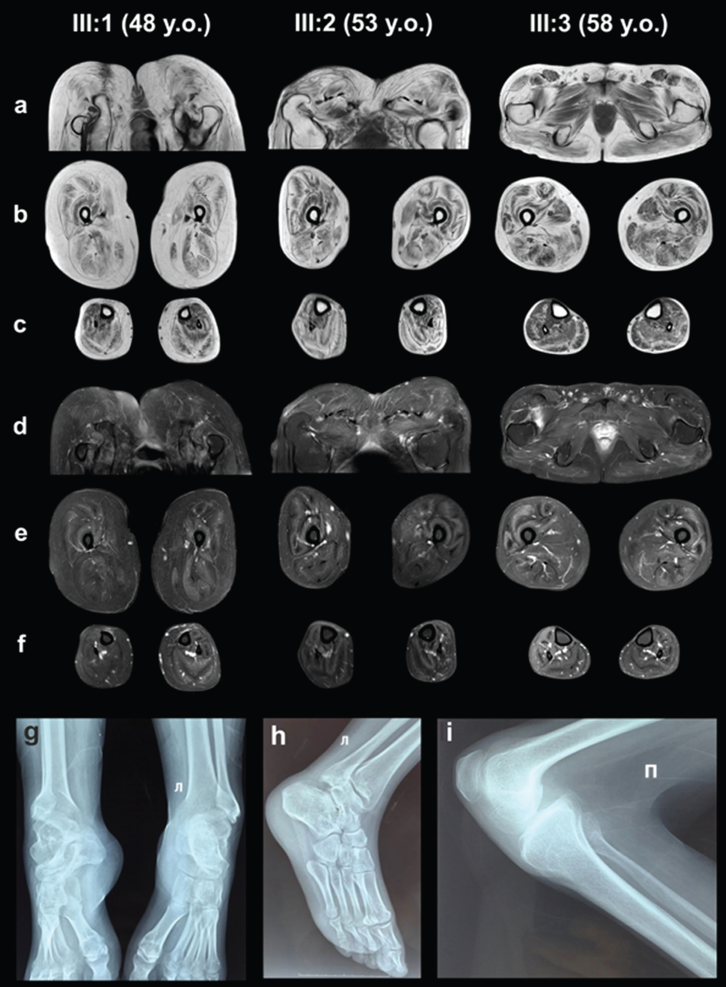 MRI of the pelvic girdle and lower extremities muscles (a, b, c –T1-WI, d, e, f –T2-WI FatSat). X-ray examination of the ankles (g, h –Patient III:1, 48 years old) and knee joint (i –Patient III:2, 53 years old).