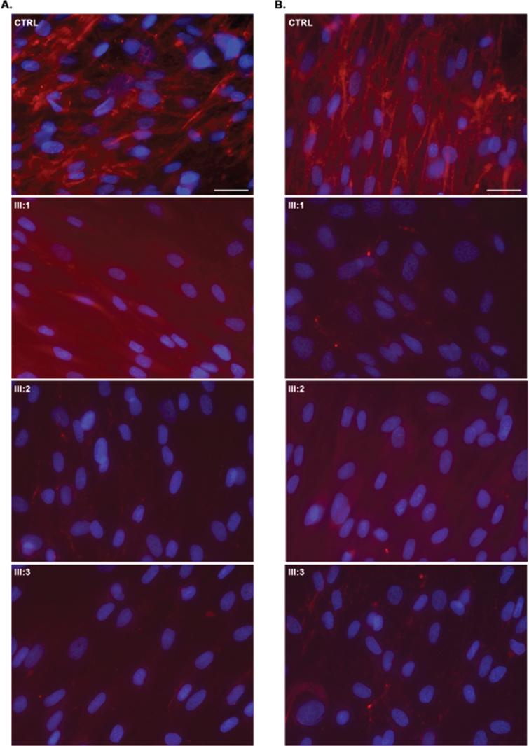 Collagen VI immunofluorescence in UCMD dermal fibroblasts (permeabilised (A) and non-permeabilised (B) conditions according to Hicks et al. (2008); CTRL –normal control, which has an abundance of well-organized collagen VI microfibrils showing a linear and unidirectional trend; III:1; III:2, III:3 –significant collagen VI rarefication with stained single extracellular microfibrils and intracellular protein retention were noticed in most cells. Dermal fibroblasts immunostained for matrix-deposited collagen VI (red) and with the nuclear stain DAPI (blue). Scale bar 50μm.