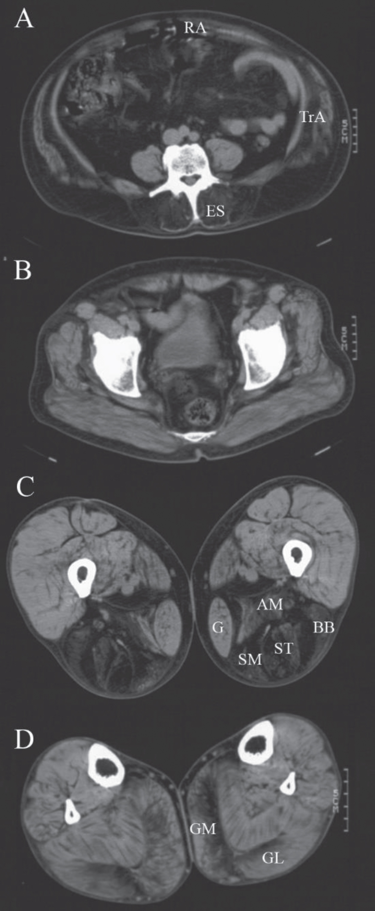 Muscle computed tomography of patient 9. CT-scan at the level of the lumbar spine (A), the pelvis (B), the thigh (C) and lower leg (D) of a male patient with GMPPB-related muscular dystrophy (LGMDR19) showing prominent fatty degeneration of the erector spinae (ES), rectus abdominis (RA), transversus abdominis (TrA), adductor magnus (AM) and hamstring (BB = biceps femoris short head, ST = semitendinosus, SM = semimembranosus) muscles and to a lesser extent of the medial (GM) and lateral gastrocnemius (GL) muscles. The gastrocnemius and gracilis (G) muscles are also increased in size (pseudohypertrophy).