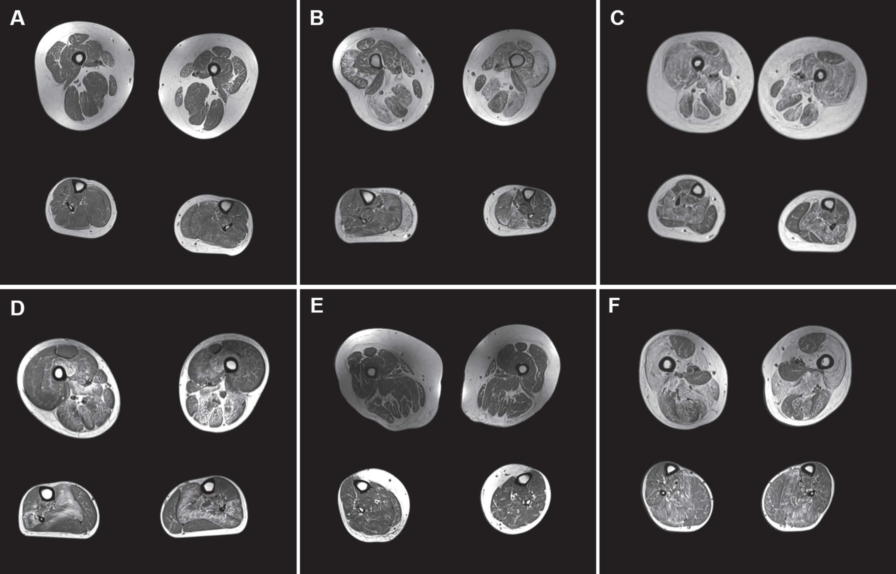 A-F: MRI of 6 clinically severe cases. Upper and lower leg slices from cases with clinical severity scores > 5 (A: clinical severity score = 6; B = 5; C = 6; D = 7; E = 6; F = 5) with relative sparing of rectus femoris (in A, E, and F), adductor longus and gracilis in the upper leg, and soleus being the most affected muscle in the lower leg.