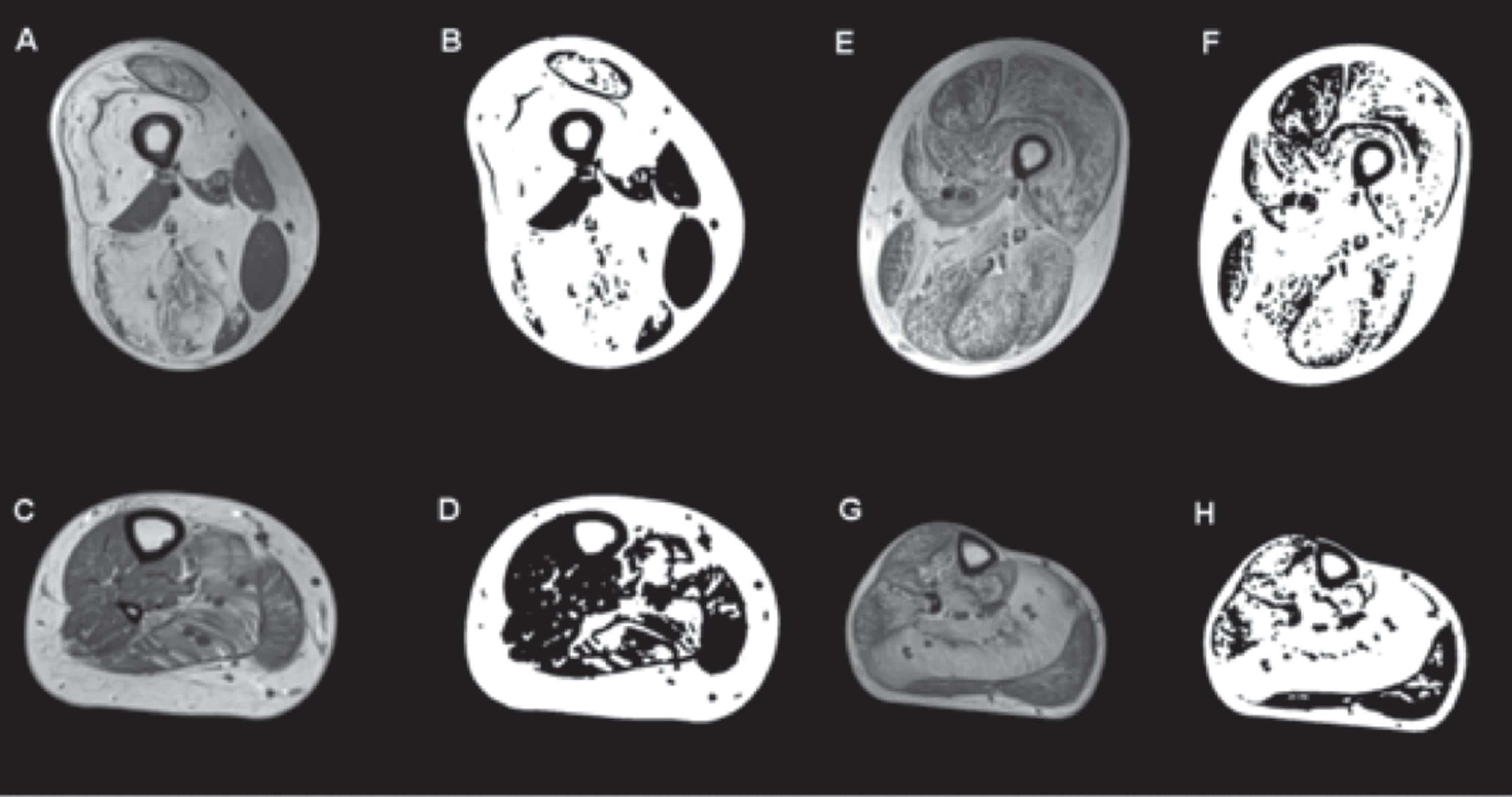 T1-weighted MRI and images generated using an ImageJ-derived quantification script showing selective muscle fatty infiltration in RYR1-RM. Transverse sections of the proximal thigh and lower leg in a dominantly inherited case (#11: A and C are the MR images of the upper and lower leg respectively, B and D are the quantification images generated by ImageJ script) and a recessive case (#8: E and G are the MR images of the upper and lower leg respectively, and F and H are their quantification images). In the dominant case, there is relative sparing of rectus femoris, adductor longus, and hypertrophied gracilis in the upper thigh, and in the lower leg the soleus and gastrocnemius lateralis are the most affected while the tibialis anterior, peroneal group, and gastrocnemius medialis are relatively spared. In the recessive case, all muscle groups are affected in the upper leg, including the tibialis anterior and peroneal group in the lower leg, with the soleus being the most affected. No statistically significant difference in intramuscular fatty infiltration was observed between dominant and recessive cases.