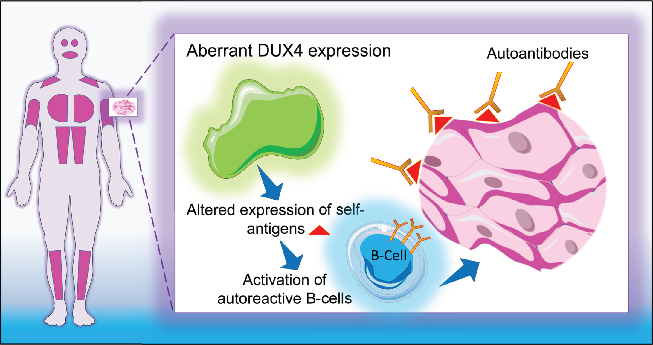 Graphical representation of study hypothesis. DUX4-induced aberrant expression of genes triggers a sustained autoimmune reaction against skeletal muscle cells.
