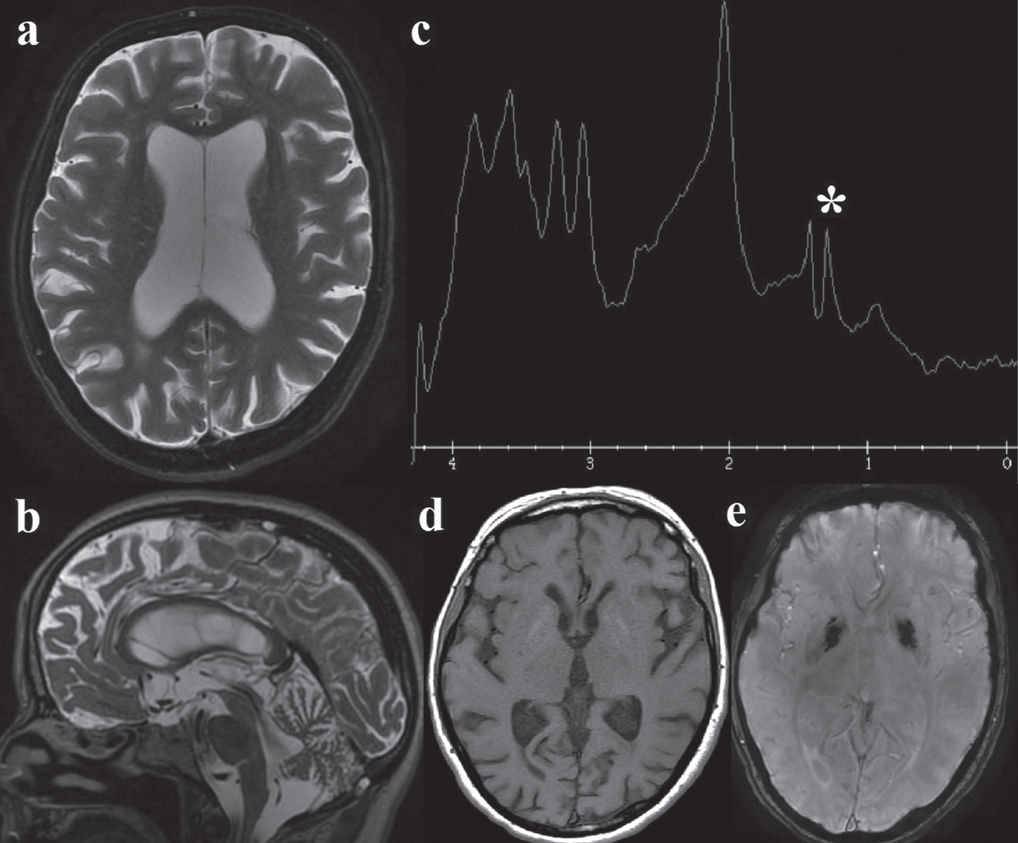 Brain MRI: a. Axial T2, showing global cerebral atrophy with ex-vacuo lateral ventricles dilatation; b. Sagittal T2, cerebellar atrophy; c. MR spectroscopy: the white asterisk (*) marks the lactate peak; d. axial T1 and e. susceptibility-weighted angiography (SWAN): mild bipallidal calcifications.