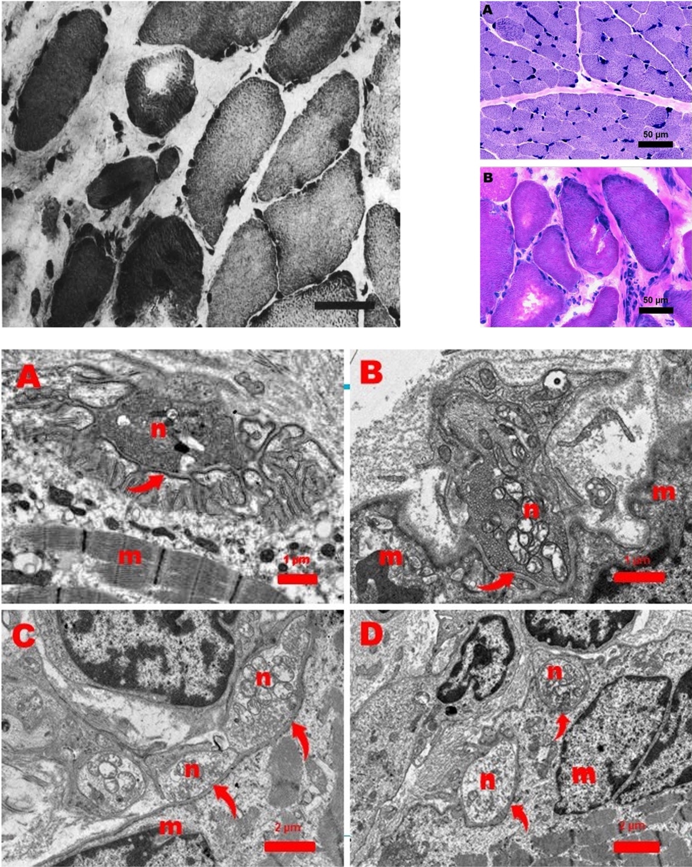 Top left: Original image of muscle biopsy of the diaphragm showing a dystrophic aspect with many hypertrophic muscle fibers in a matrix of connective tissue, as published in the report by Leijten et al. Top right: Muscle biopsy from the quadriceps muscle (A) and diaphragm muscle (B). Quadriceps muscle is normal. However, the diaphragm shows a dystrophic picture with hypertrophic fibers and increase of endomysial connective tissue. Bar: 50 micron. Hematoxilin-Phloxine (HP) stain. Bottom: Ultrastructure of a normal neuromuscular junction (NMJ) from a 11-month-old girl (Figure A). Figures B, C, and D show abnormal NJMs in the diaphragm of the patient in this report. Arrows point to the primary cleft between the neuronal (n) and muscular (m) part of the NMJs (Figure A, B, C, and D). The neuronal part (n) of the NMJs contains mitochondria and small vesicles with acetylcholine. Note the presence of many secondary clefts invaginating the muscular part (Figure A) and the almost complete absence of these invaginations in the abnormal NMJs.